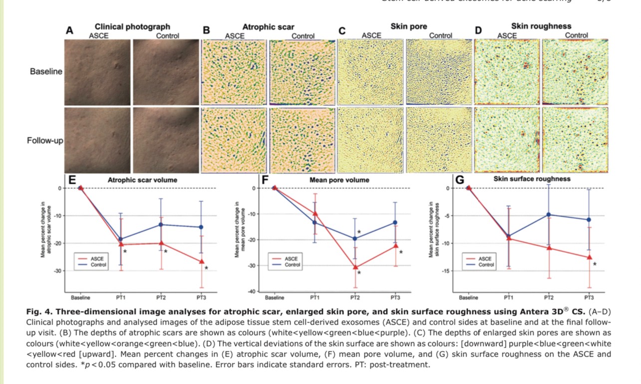 แนะนำเทคนิคในการดูแลหลุมสิว: Exosome ใน การรักษาหลุมสิว (Exosome & acne scar treatment) แนะนำเทคนิคในการดูแลหลุมสิว: Exosome ใน การรักษาหลุมสิว (Exosome & acne scar treatment)