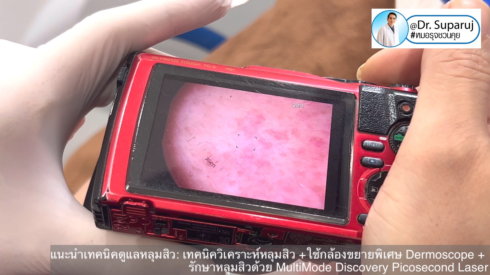 แนะนำเทคนิคดูแลหลุมสิว: เทคนิควิเคราะห์หลุมสิว +ใช้กล้องขยายพิเศษ Dermoscope + รักษาหลุมสิวด้วย MultiMode Discovery Picosecond Laser + Exosome Therapy