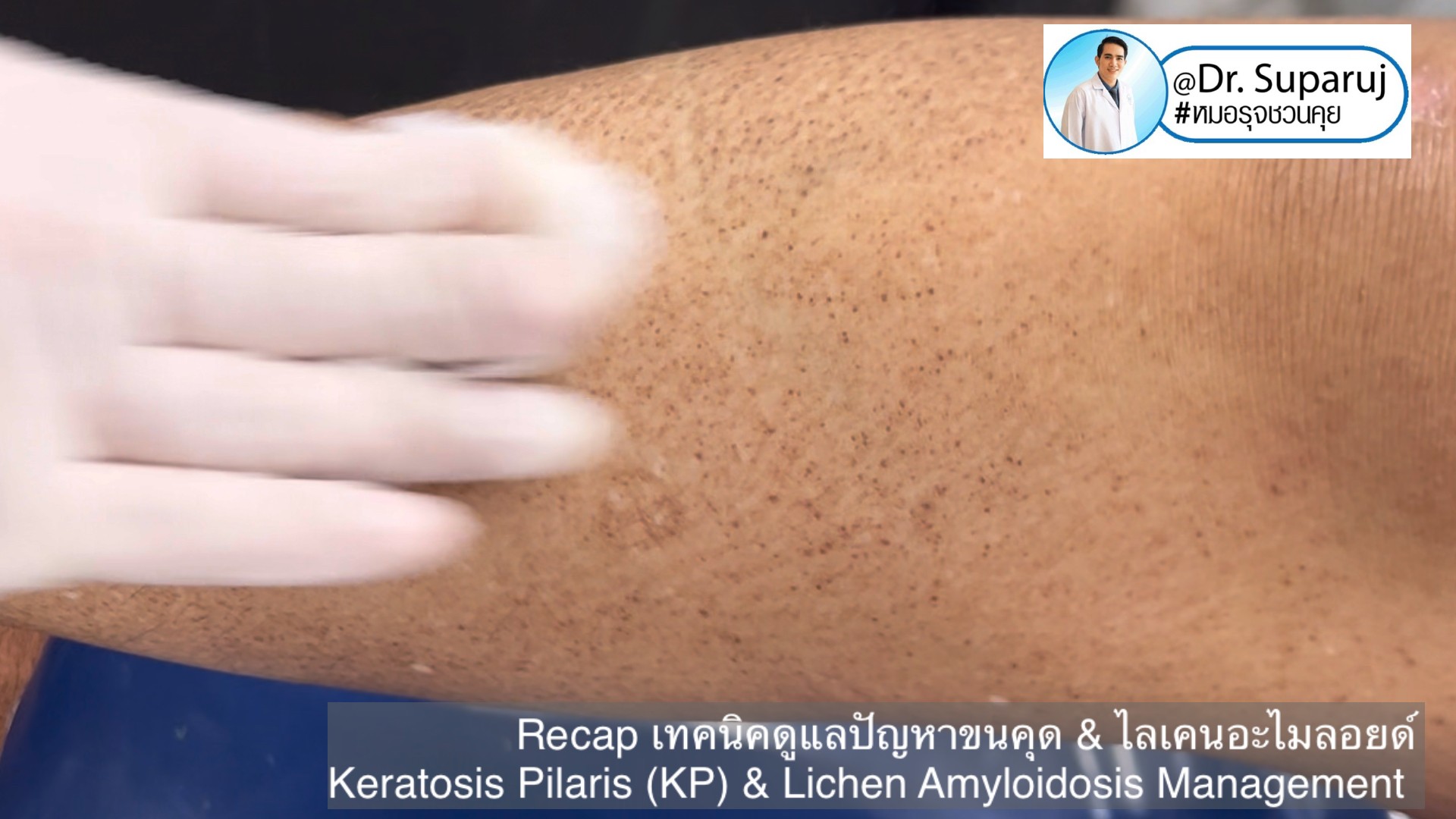 Recap เทคนิคดูแลปัญหาขนคุด & ไลเคนอะไมลอยด์ Keratosis Pilaris (KP) & Lichen Amyloidosis Management