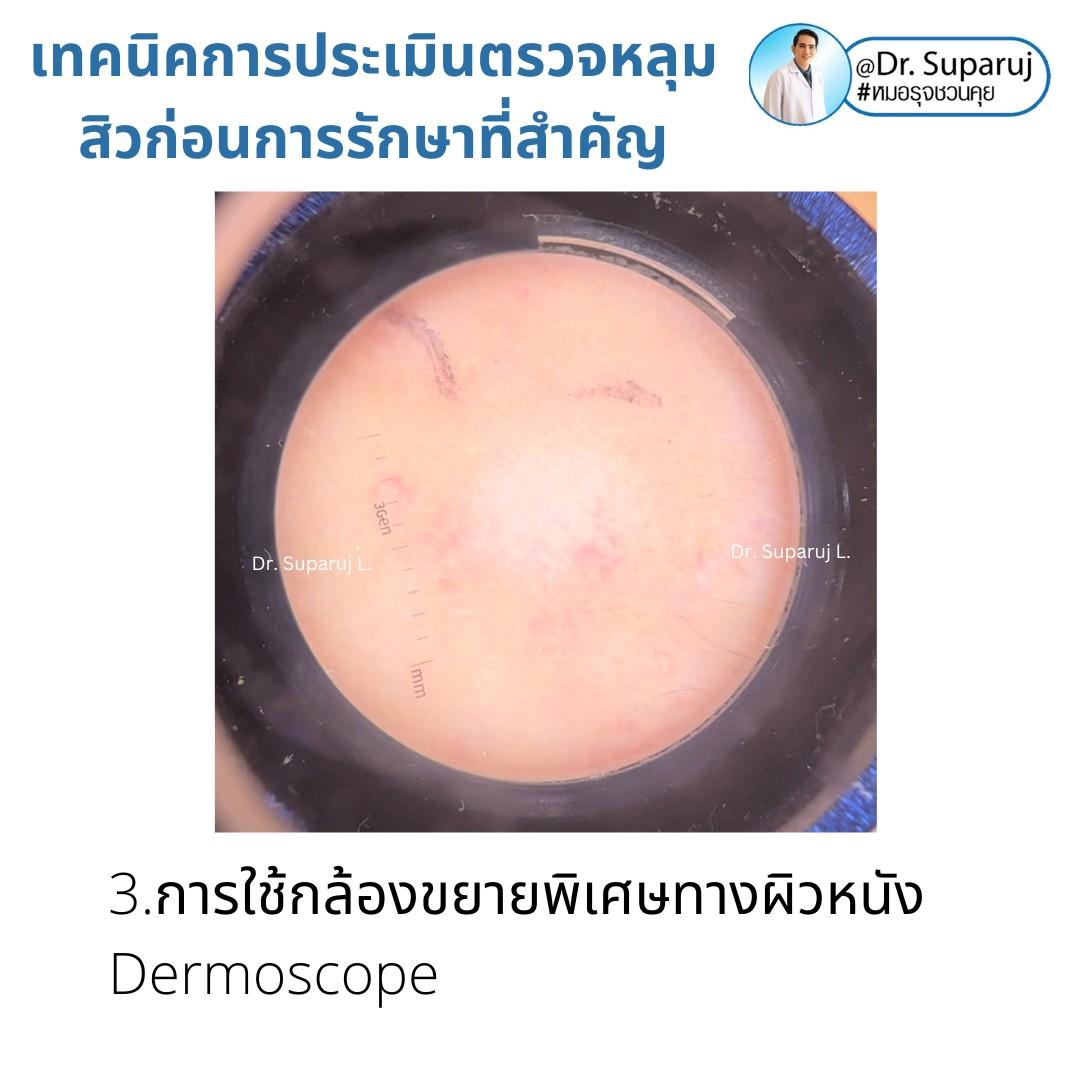 เทคนิคการประเมินตรวจหลุมสิวก่อนการรักษา Acne Scar Evaluation & Assessment เทคนิคการประเมินตรวจหลุมสิวก่อนการรักษา Acne Scar Evaluation & Assessment