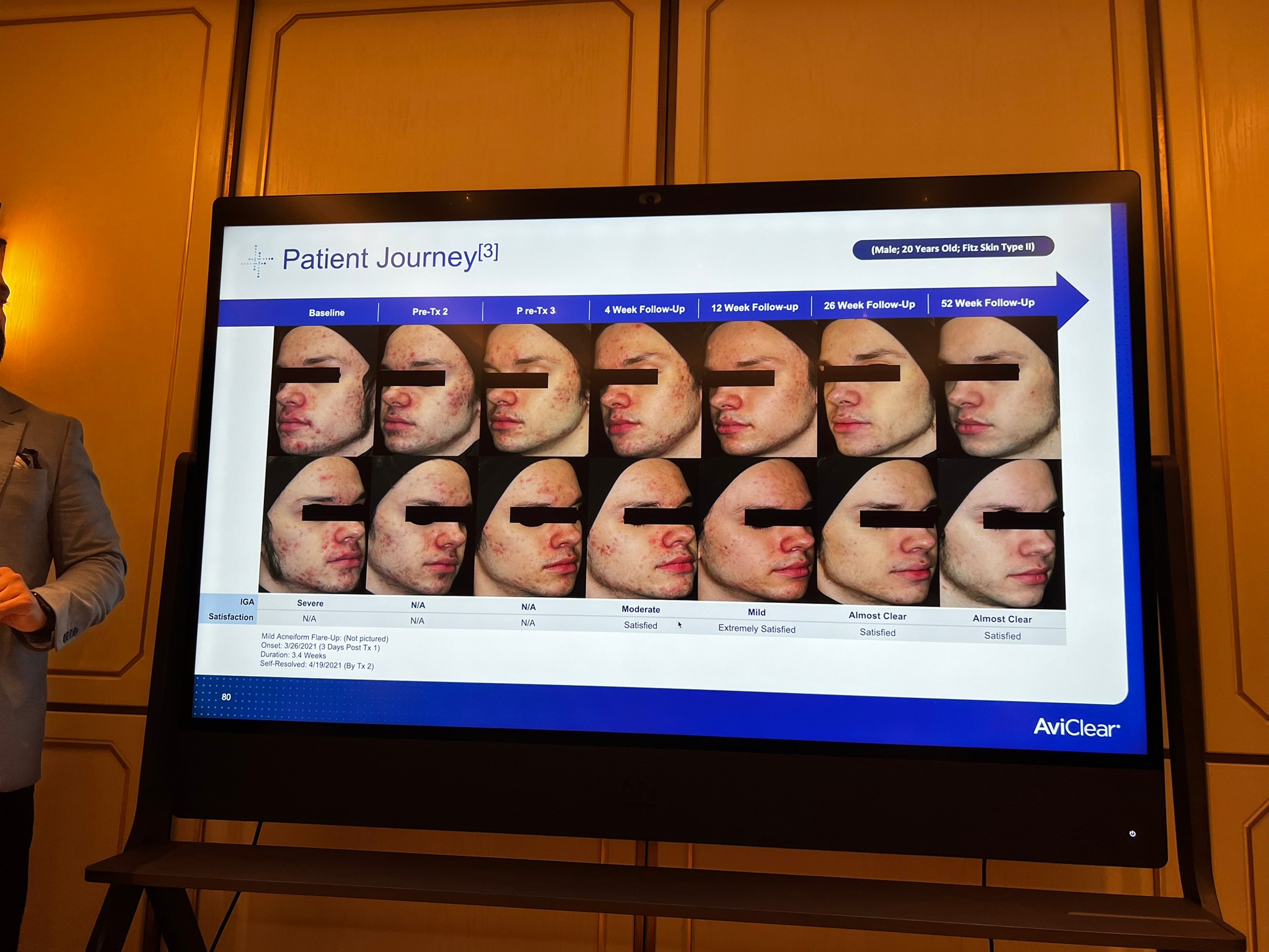 Update เครื่องเลเซอร์สำหรับรักษาสิวโดยเฉพาะ จับกับต่อมไขมันโดยตรง = AviClear 1726 nm Laser Update เครื่องเลเซอร์สำหรับรักษาสิวโดยเฉพาะ จับกับต่อมไขมันโดยตรง = AviClear 1726 nm Laser