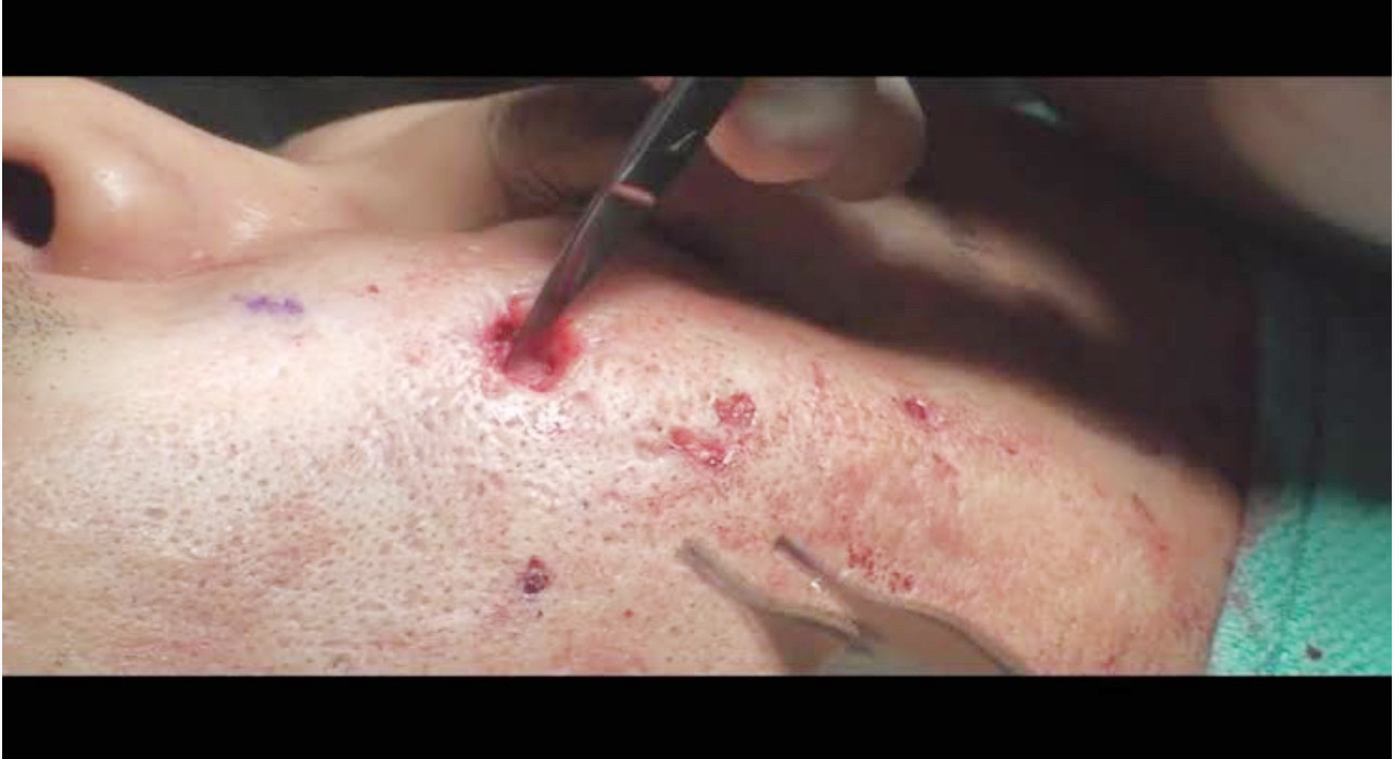 แผลเป็นจากสิวที่มีลักษณะสีขาว severe fibrotic acne scar เกิดจากอะไร & ดูแลได้อย่างไร ? แผลเป็นจากสิวที่มีลักษณะสีขาว severe fibrotic acne scar เกิดจากอะไร & ดูแลได้อย่างไร ?