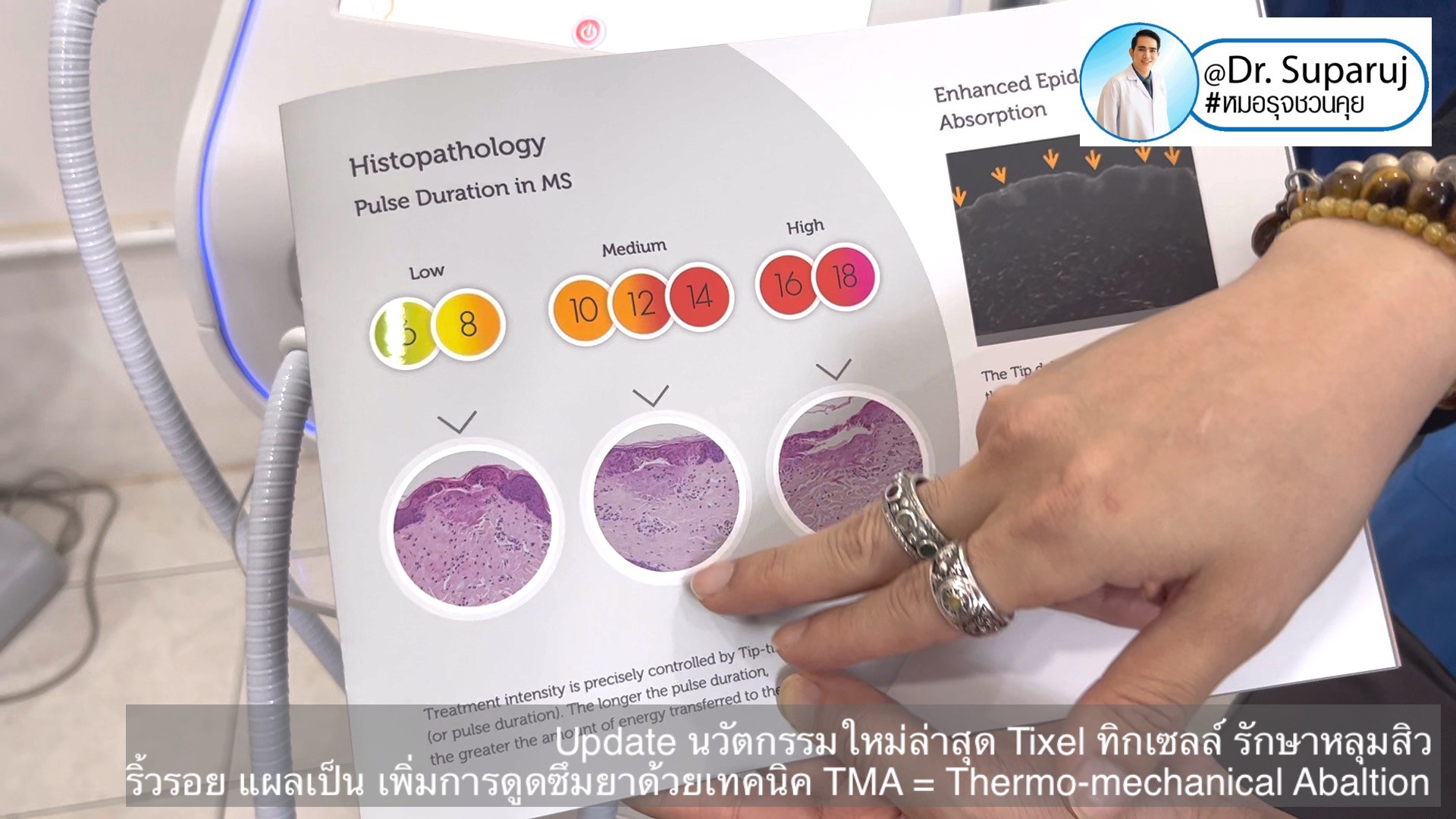 Update นวัตกรรมใหม่ล่าสุด Tixel ทิ๊กเซลล์ รักษาหลุมสิว ริ้วรอย แผลเป็น + Periorbital Tixel Treatment ดูแลริ้วรอยเปลือกตาและรอบดวงตาด้วยเทคนิค TMA = Thermo-mechanical Abaltion Update นวัตกรรมใหม่ล่าสุด Tixel ทิ๊กเซลล์ รักษาหลุมสิว ริ้วรอย แผลเป็น + Periorbital Tixel Treatment ดูแลริ้วรอยเปลือกตาและรอบดวงตาด้วยเทคนิค TMA = Thermo-mechanical Abaltion