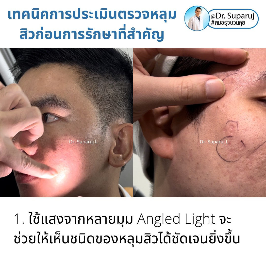 เทคนิคการประเมินตรวจหลุมสิวก่อนการรักษา Acne Scar Evaluation & Assessment