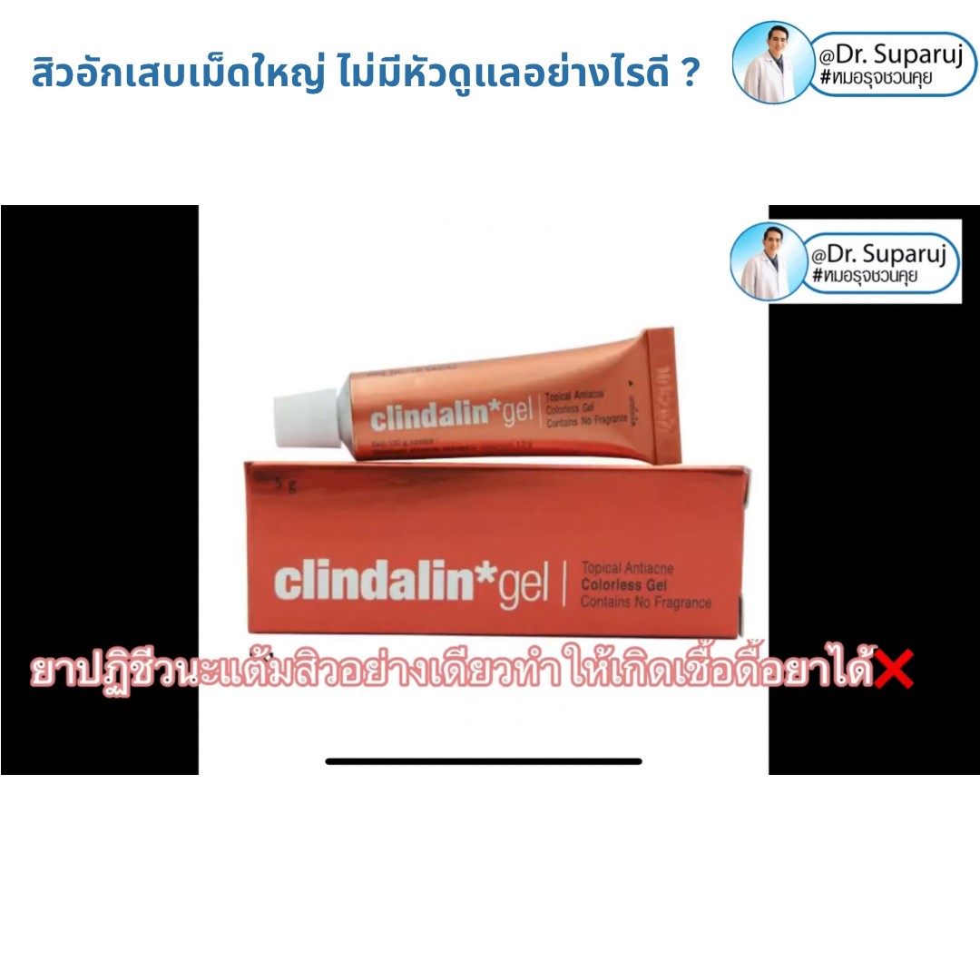 มีสิวอักเสบเม็ดใหญ่ ไม่มีหัว ขึ้น ดูแลอย่างไรดี ? มีสิวอักเสบเม็ดใหญ่ ไม่มีหัว ขึ้น ดูแลอย่างไรดี ?