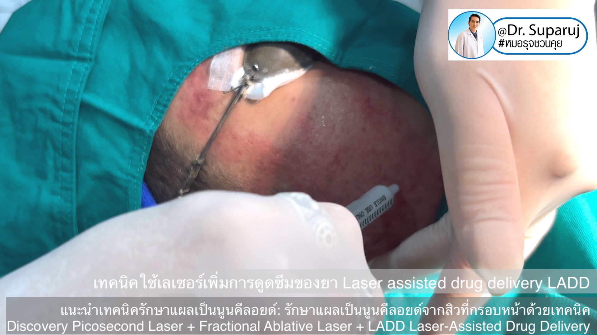 แนะนำเทคนิคดูแลแผลเป็นนูนคีลอยด์: รักษาแผลเป็นนูนคีลอยด์จากสิวที่กรอบหน้าด้วยเทคนิค Discovery Picosecond Laser + Fractional Ablative Laser + LADD Laser-Assisted Drug Delivery แนะนำเทคนิคดูแลแผลเป็นนูนคีลอยด์: รักษาแผลเป็นนูนคีลอยด์จากสิวที่กรอบหน้าด้วยเทคนิค Discovery Picosecond Laser + Fractional Ablative Laser + LADD Laser-Assisted Drug Delivery