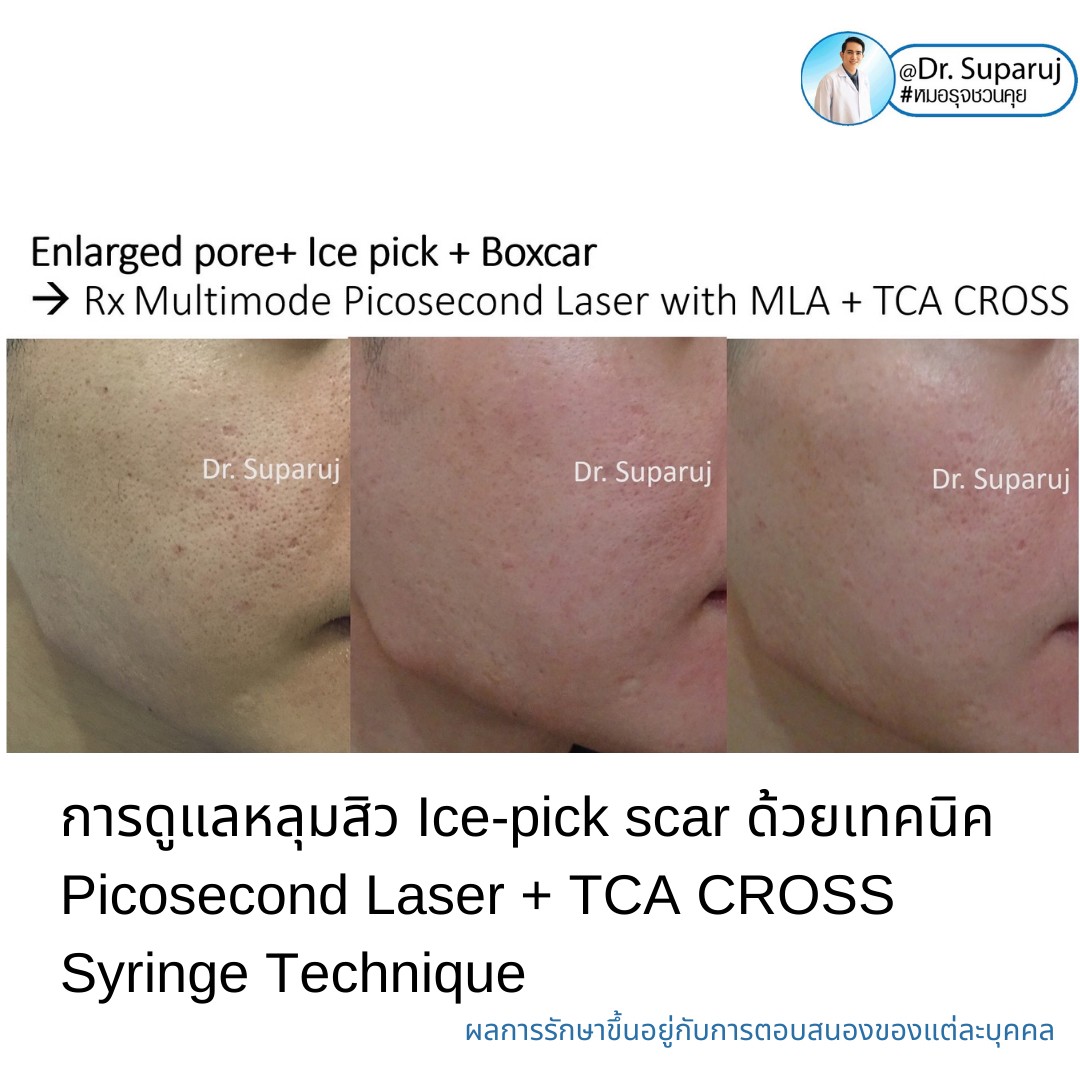 แนะนำเทคนิครักษาหลุมสิวจิกลึก Ice Pick Acne Scar ด้วยเทคนิคเลเซอร์ UltraDeep Pico Technique (Ice Pick Acne Scar Treatment with Discovery Pico Laser + UltraDeep Pico Technique) แนะนำเทคนิครักษาหลุมสิวจิกลึก Ice Pick Acne Scar ด้วยเทคนิคเลเซอร์ UltraDeep Pico Technique (Ice Pick Acne Scar Treatment with Discovery Pico Laser + UltraDeep Pico Technique)