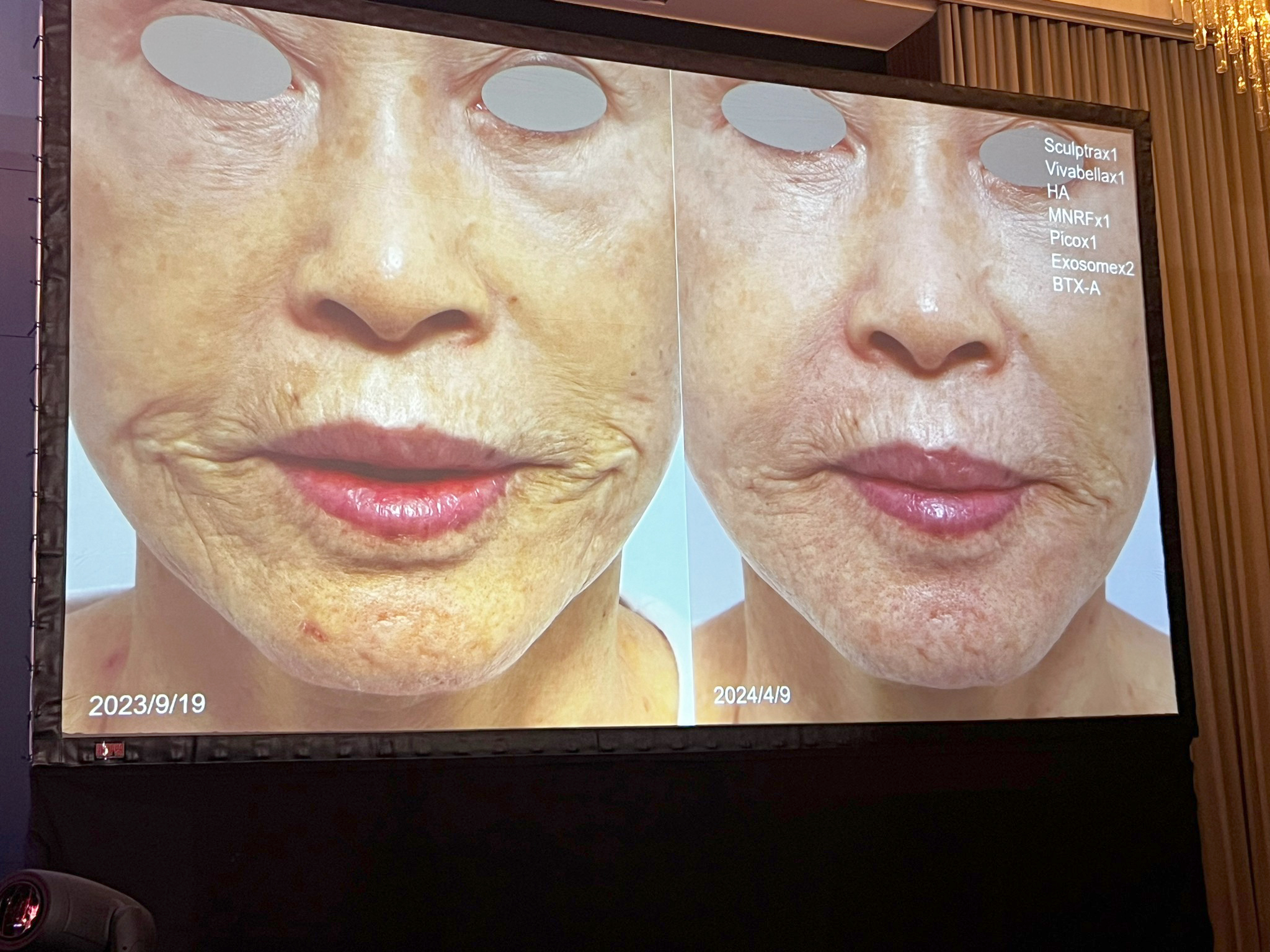 หมอรุจ ผศ. นพ. ศุภะรุจ เลื่องอรุณ ได้รับเกียรติร่วมบรรยายแชร์เทคนิคการดูแลปัญหาผิวหนัง เช่น หลุมสิว แผลเป็น ปัญหาเส้นผม ฝ้า กับแพทย์ผู้เชี่ยวชาญระดับแนวหน้าของประเทศไต้หวัน เช่น หมอรุจ ผศ. นพ. ศุภะรุจ เลื่องอรุณ ได้รับเกียรติร่วมบรรยายแชร์เทคนิคการดูแลปัญหาผิวหนัง เช่น หลุมสิว แผลเป็น ปัญหาเส้นผม ฝ้า กับแพทย์ผู้เชี่ยวชาญระดับแนวหน้าของประเทศไต้หวัน เช่น