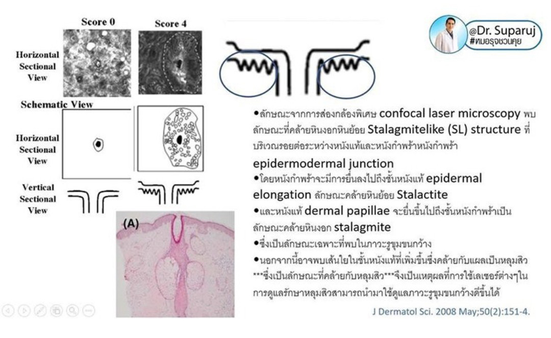 รูขุมขนกว้าง Enlarged Facial Pore เกิดจากอะไร ? + เทคนิคดูแลด้วยโปรแกรม Discovery Pico Laser หลายความยาวคลื่น +หลายพลังงานร่วมกัน รูขุมขนกว้าง Enlarged Facial Pore เกิดจากอะไร ? + เทคนิคดูแลด้วยโปรแกรม Discovery Pico Laser หลายความยาวคลื่น +หลายพลังงานร่วมกัน