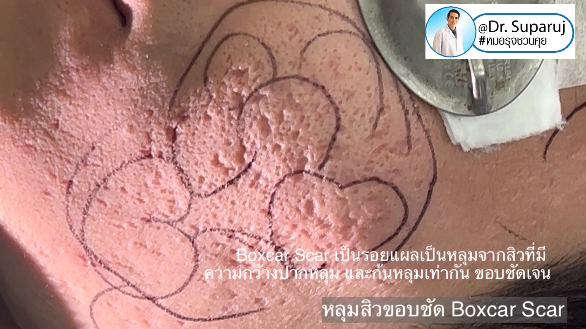 Back to the Basics: หลุมสิวมีกี่ชนิด & มีลักษณะอย่างไร ? Acne Scar Classification Full Clip คลิปเต็ม Facebook/ YouTube Dr. Suparuj หมอรุจชวนคุย ครับ Back to the Basics: หลุมสิวมีกี่ชนิด & มีลักษณะอย่างไร ? Acne Scar Classification Full Clip คลิปเต็ม Facebook/ YouTube Dr. Suparuj หมอรุจชวนคุย ครับ