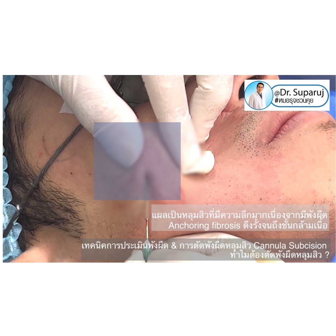 เป็นหลุมสิว แต่ยังไม่พร้อมรักษาหลุมสิว ทำอย่างไรดี? (+ เทคนิคการ เลือกใช้วิธีรักษาลุมสิวเบื้องต้นครับ) เป็นหลุมสิว แต่ยังไม่พร้อมรักษาหลุมสิว ทำอย่างไรดี? (+ เทคนิคการ เลือกใช้วิธีรักษาลุมสิวเบื้องต้นครับ)