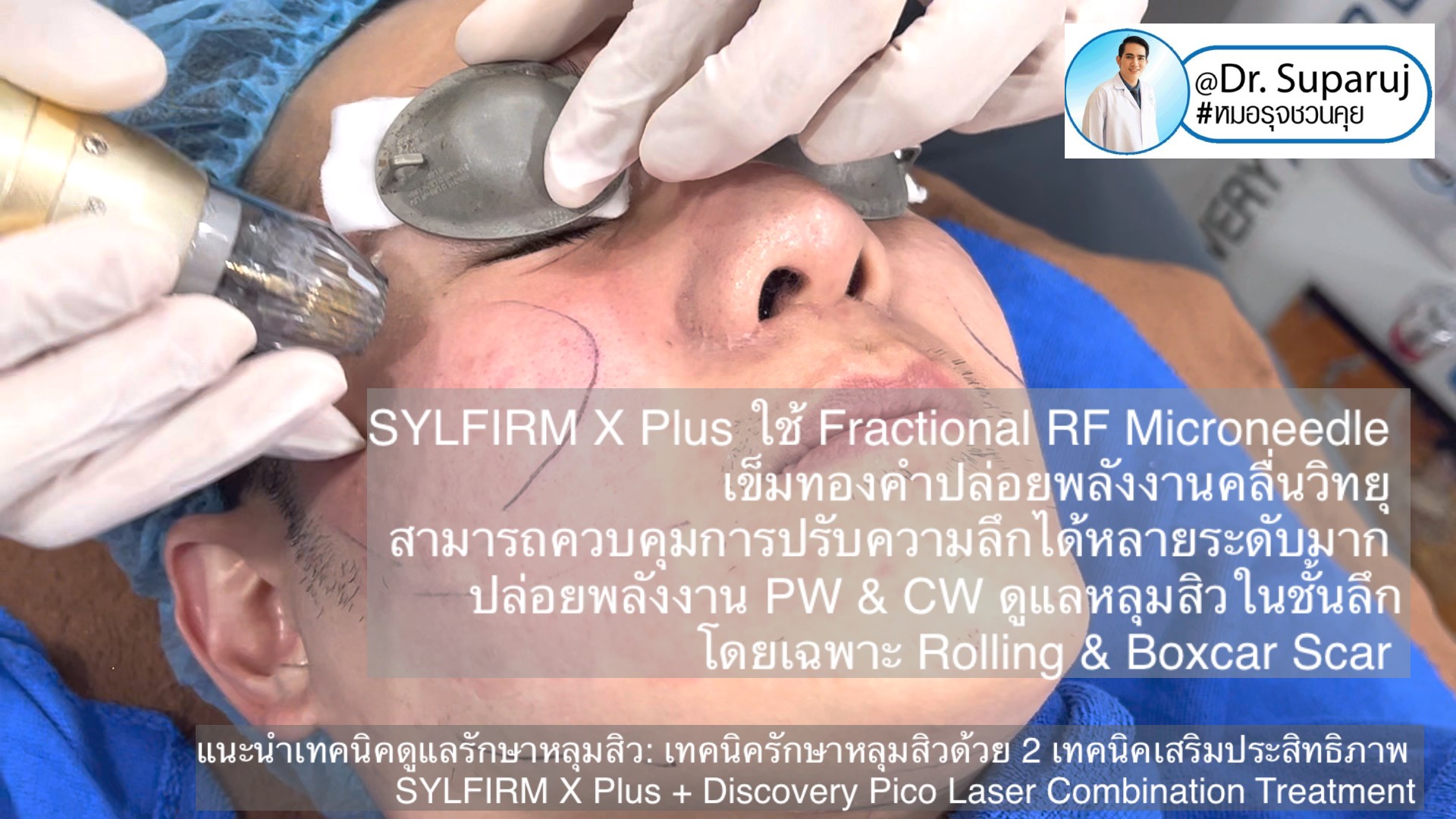 แนะนำเทคนิคดูแลรักษาหลุมสิว: เทคนิครักษาหลุมสิวด้วย 2 เทคนิคเสริมประสิทธิภาพ SYLFIRM X Plus + Discovery Pico Laser Combination Treatment แนะนำเทคนิคดูแลรักษาหลุมสิว: เทคนิครักษาหลุมสิวด้วย 2 เทคนิคเสริมประสิทธิภาพ SYLFIRM X Plus + Discovery Pico Laser Combination Treatment