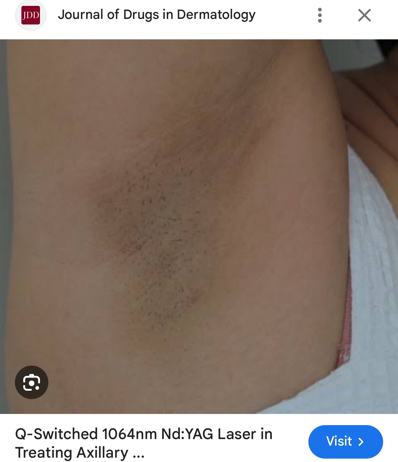 รักแร้ดำเกิดจากสาเหตุอะไร & ดูแลอย่างไร ? รักแร้ดำเกิดจากสาเหตุอะไร & ดูแลอย่างไร ?