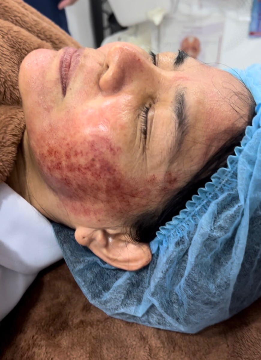 เทคนิคดูแลผิวลดรอยแดงหลังการรักษาหลุมสิว Discovery Pico Laser ด้วย ASCE + Soothing Gel Mask: ช่วยลดรอยแดงได้จริงไหม ? (ท้ายคลิปมีตัวอย่างผลการรักษาครับ) เทคนิคดูแลผิวลดรอยแดงหลังการรักษาหลุมสิว Discovery Pico Laser ด้วย ASCE + Soothing Gel Mask: ช่วยลดรอยแดงได้จริงไหม ? (ท้ายคลิปมีตัวอย่างผลการรักษาครับ)