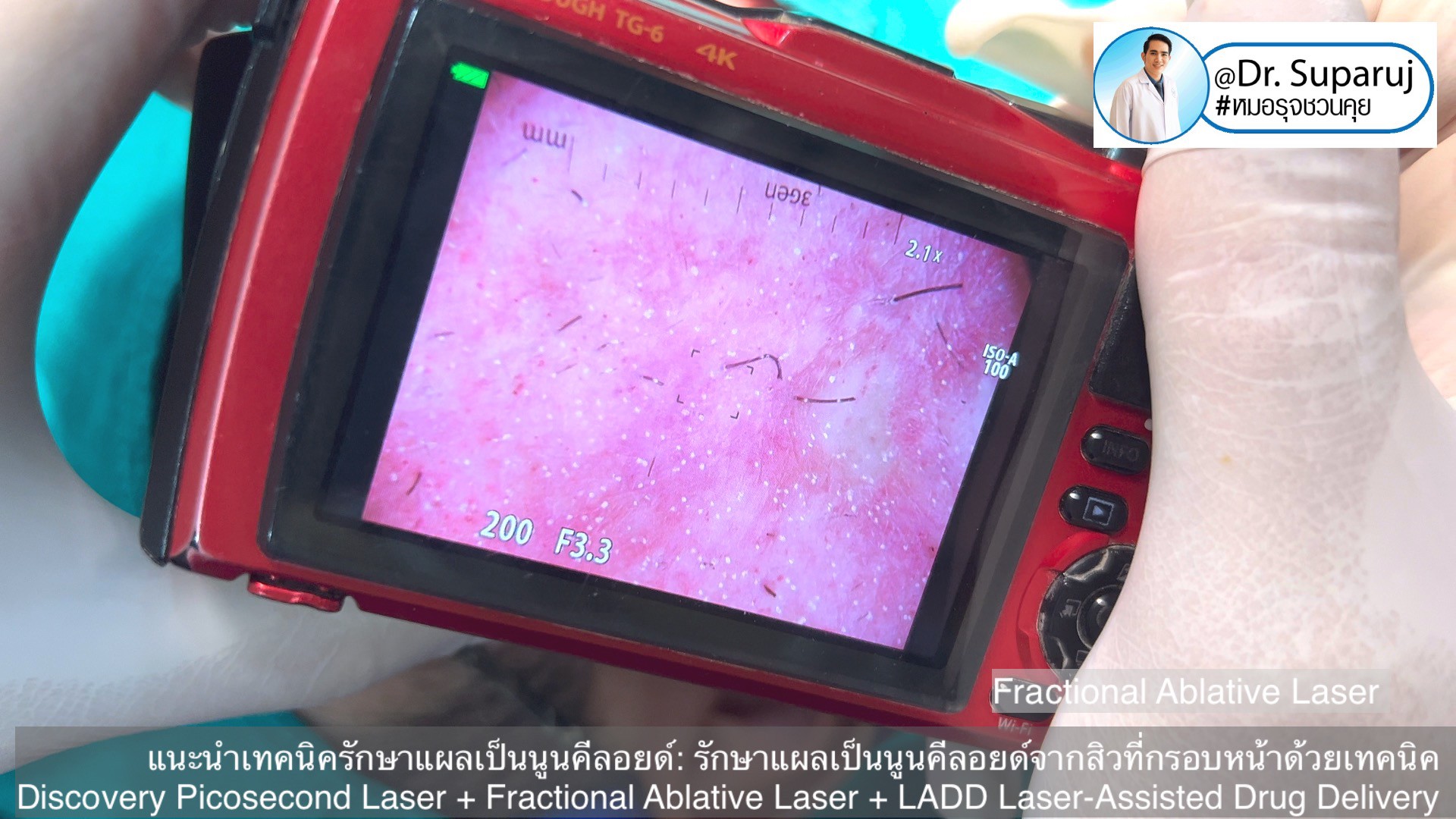 แนะนำเทคนิคดูแลแผลเป็นนูนคีลอยด์: รักษาแผลเป็นนูนคีลอยด์จากสิวที่กรอบหน้าด้วยเทคนิค Discovery Picosecond Laser + Fractional Ablative Laser + LADD Laser-Assisted Drug Delivery แนะนำเทคนิคดูแลแผลเป็นนูนคีลอยด์: รักษาแผลเป็นนูนคีลอยด์จากสิวที่กรอบหน้าด้วยเทคนิค Discovery Picosecond Laser + Fractional Ablative Laser + LADD Laser-Assisted Drug Delivery