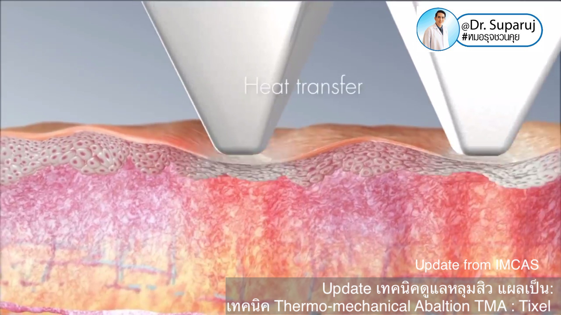 Update from IMCAS เทคนิครักษาหลุมสิว แผลเป็น ริ้วรอย: Tixel เทคนิค Thermo-mechanical Abaltion TMA Update from IMCAS เทคนิครักษาหลุมสิว แผลเป็น ริ้วรอย: Tixel เทคนิค Thermo-mechanical Abaltion TMA