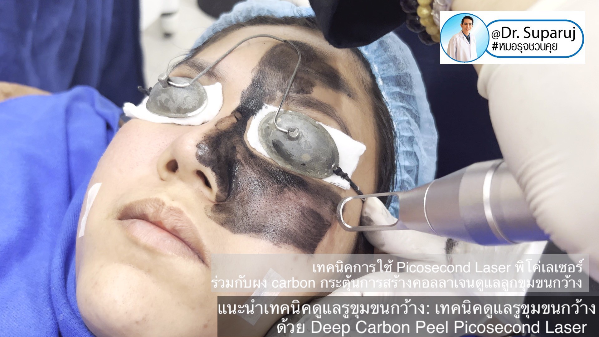 แนะนำเทคนิคดูแลรูขุมขนกว้าง: เทคนิคดูแลรูขุมขนกว้างด้วย Deep Carbon Peel Picosecond Laser (เทคนิคการใช้ Picosecond Laser พิโค่เลเซอร์ ร่วมกับผง carbon กระตุ้นการสร้างคอลลาเจนดูแลรูขุมขนกว้าง )