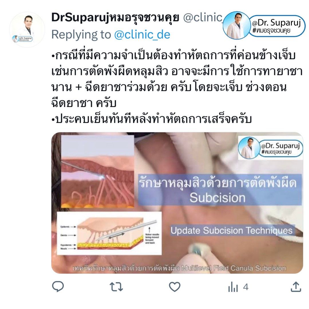 เป็นคนเจ็บง่าย (มากๆ) แต่อยากรักษาหลุมสิว มีเทคนิคอย่างไร? : เทคนิคลดอาการเจ็บจากการรักษาหลุมสิว เป็นคนเจ็บง่าย (มากๆ) แต่อยากรักษาหลุมสิว มีเทคนิคอย่างไร? : เทคนิคลดอาการเจ็บจากการรักษาหลุมสิว