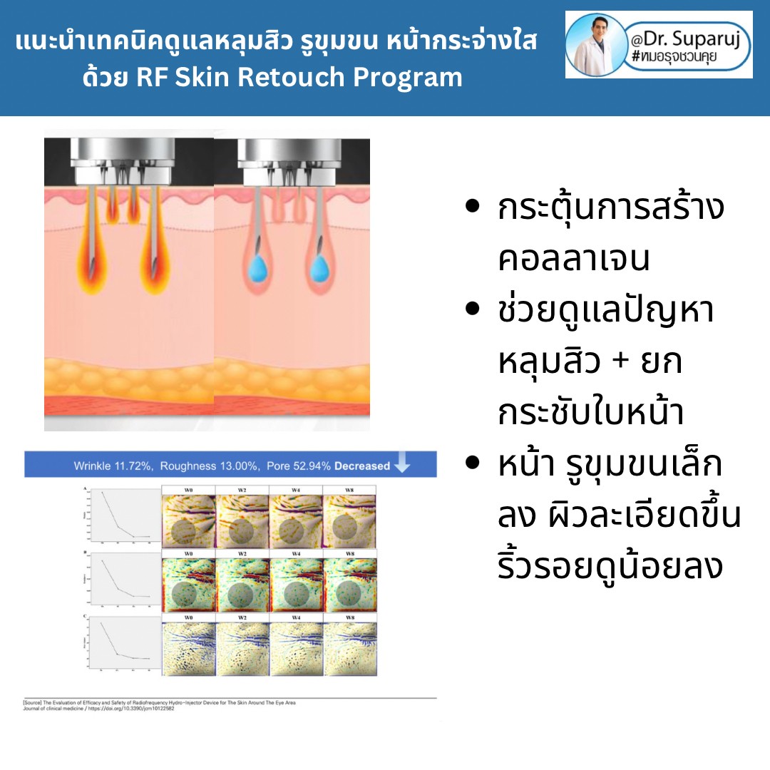แนะนำเทคนิคดูแลหลุมสิว รูขุมขน หน้ากระจ่างใสด้วย RF Skin Retouch Program แนะนำเทคนิคดูแลหลุมสิว รูขุมขน หน้ากระจ่างใสด้วย RF Skin Retouch Program