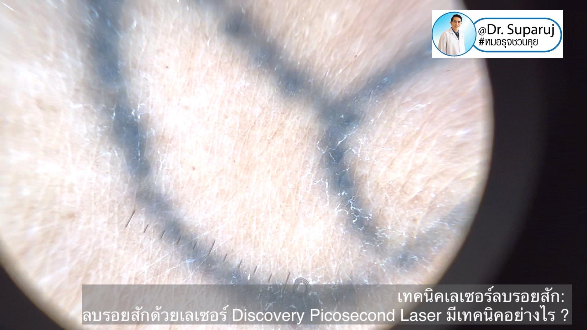 แนะนำเทคนิคเลเซอร์ลบรอยสักด้วย Picosecond Laser: ลบรอยสักด้วยเลเซอร์ Discovery Picosecond Laser มีเทคนิคอย่างไร ? แนะนำเทคนิคเลเซอร์ลบรอยสักด้วย Picosecond Laser: ลบรอยสักด้วยเลเซอร์ Discovery Picosecond Laser มีเทคนิคอย่างไร ?