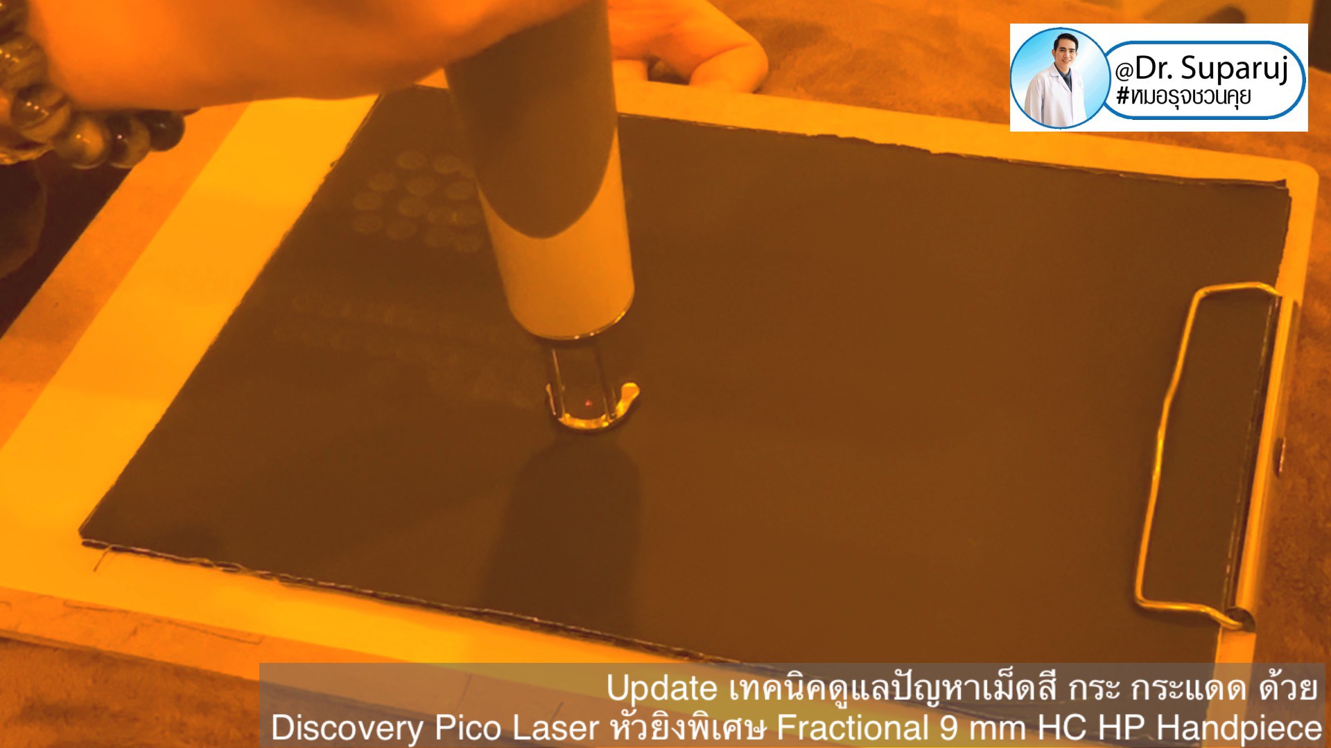 Update เทคนิคดูแลปัญหาเม็ดสี กระ กระแดด ด้วย Discovery Pico Laser หัวยิงเลเซอร์พิเศษ Fractional 9 mm HC HP Handpiece