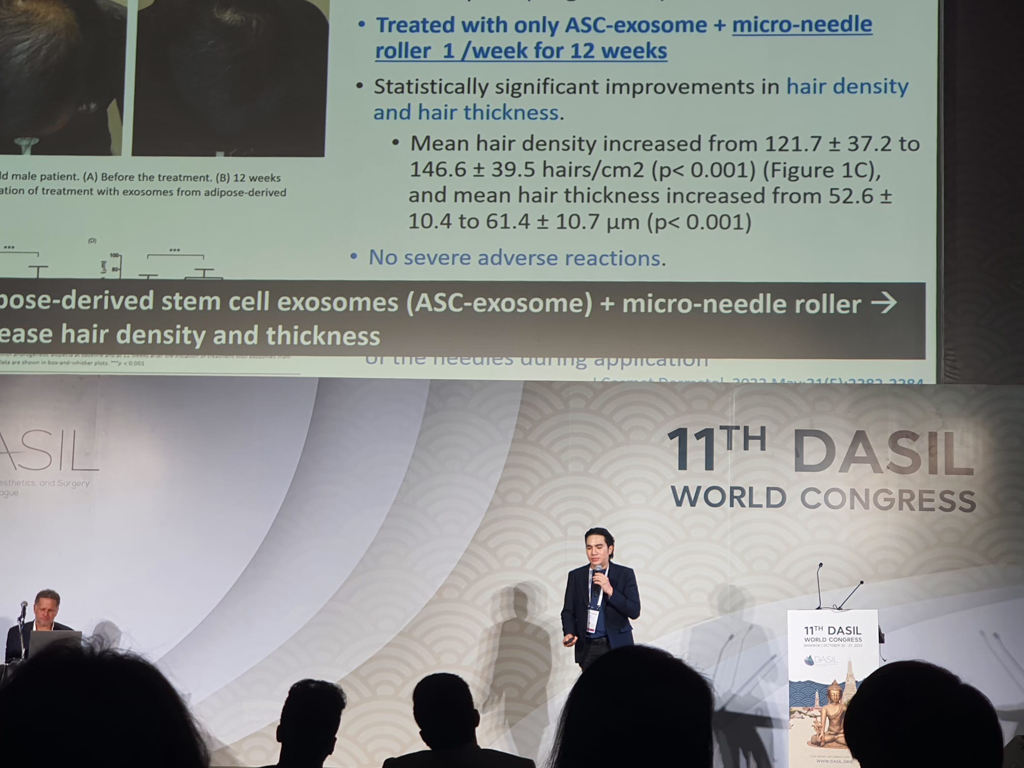 ผศ.นพ. ศุภะรุจ เลื่องอรุณ (หมอรุจ) ได้รับรางวัล DASIL Outstanding Award และ ได้รับเกียรติรับเชิญเป็นวิทยากร ในการประชุมแพทย์ผิวหนังระดับนานาชาติ DASIL 2023 Bangkok (Dermatology, Aesthetics, and Surgery International League) ผศ.นพ. ศุภะรุจ เลื่องอรุณ (หมอรุจ) ได้รับรางวัล DASIL Outstanding Award และ ได้รับเกียรติรับเชิญเป็นวิทยากร ในการประชุมแพทย์ผิวหนังระดับนานาชาติ DASIL 2023 Bangkok (Dermatology, Aesthetics, and Surgery International League)