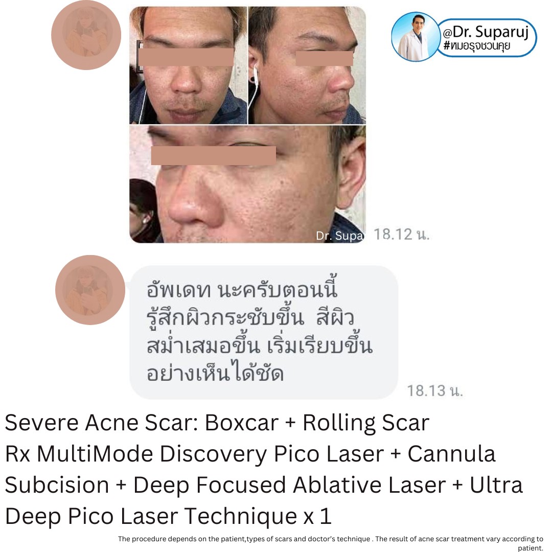 Update รักษาหลุมสิวด้วยเทคนิคการตัดพังผืด Blunt Blade Subcision (Blunt Blade Subcision for Acne Scar Fibrosis Treatment)