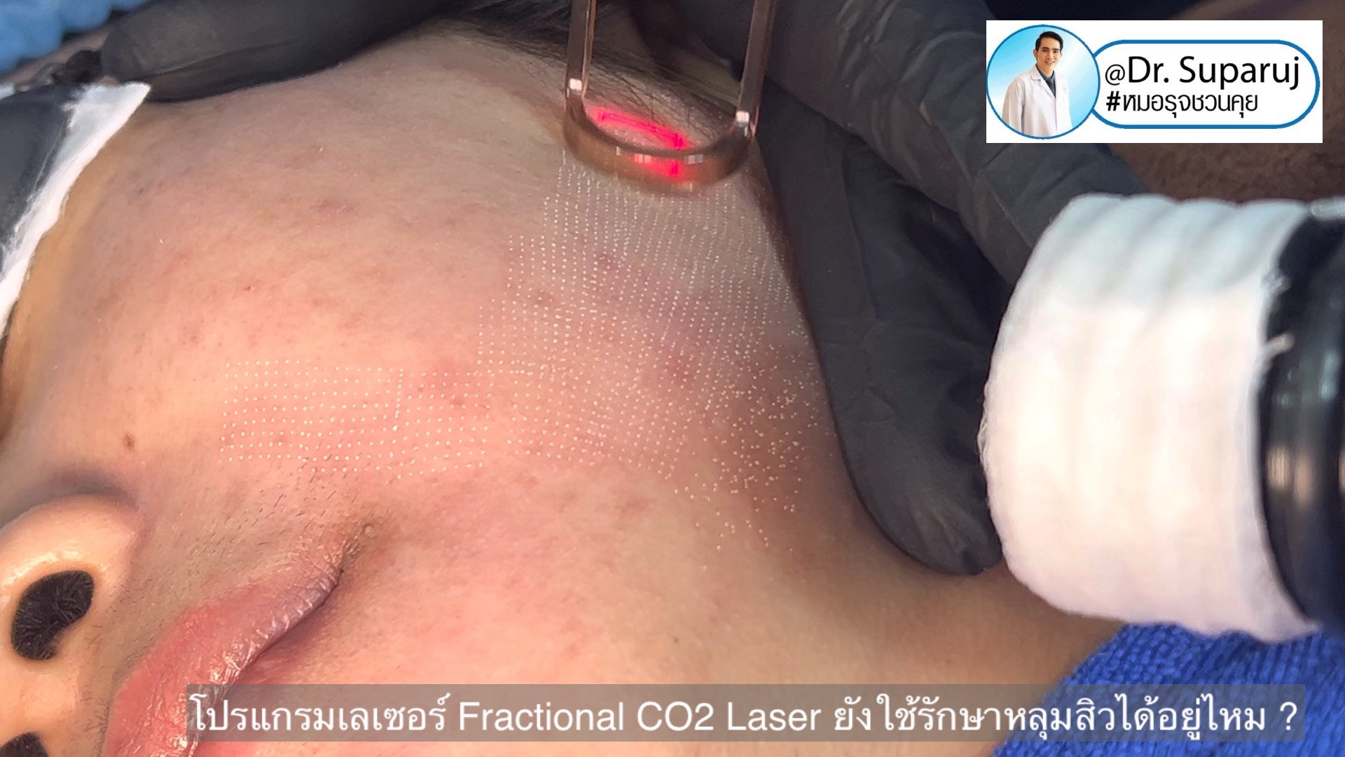 โปรแกรมเลเซอร์ Fractional CO2 Laser ยังใช้รักษาหลุมสิวได้อยู่ไหม ? โปรแกรมเลเซอร์ Fractional CO2 Laser ยังใช้รักษาหลุมสิวได้อยู่ไหม ?