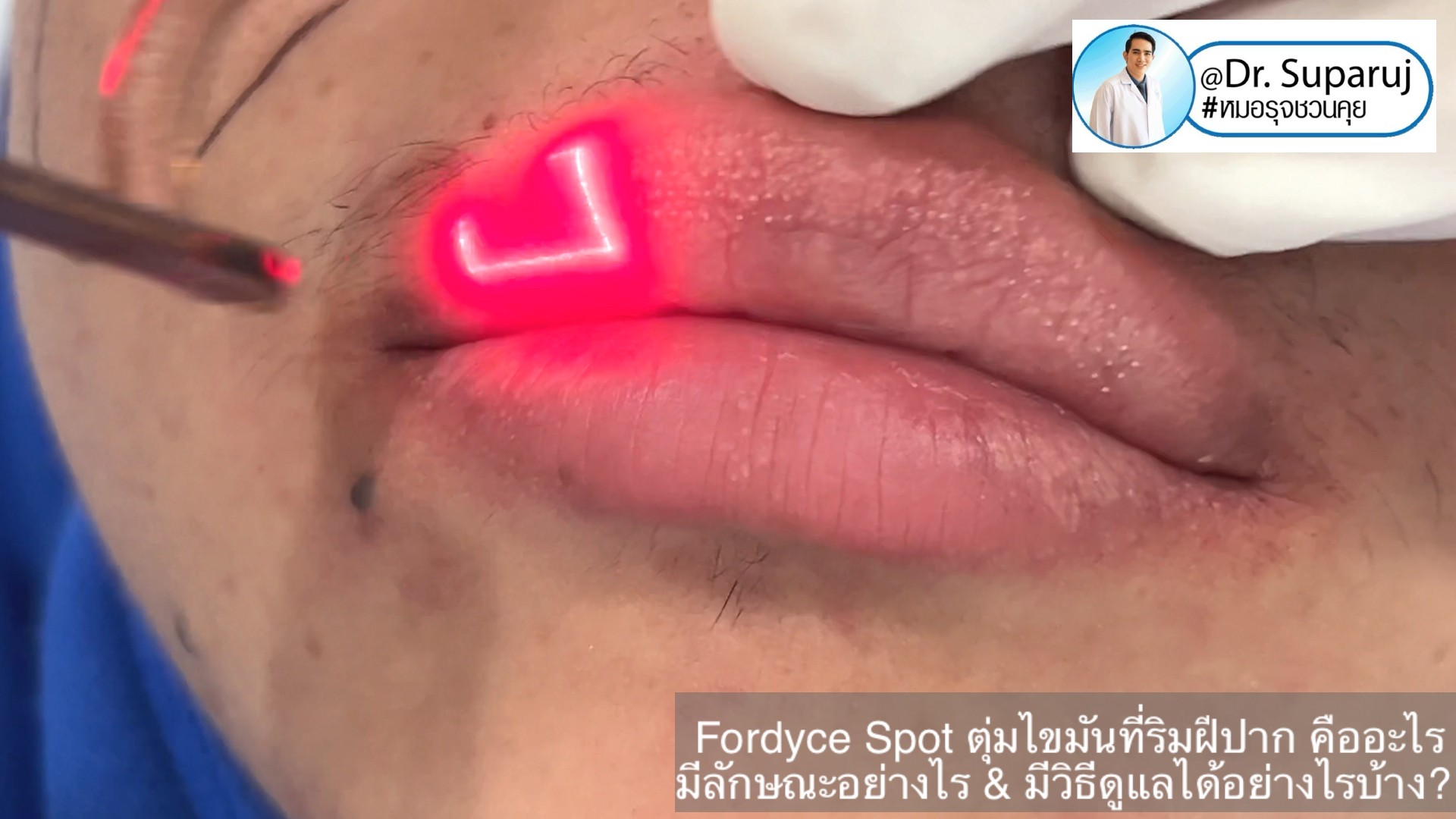 Fordyce Spot ตุ่มไขมันที่ริมฝีปาก คืออะไร มีลักษณะอย่างไร & มีวิธีดูแลได้อย่างไรบ้าง? Fordyce Spot ตุ่มไขมันที่ริมฝีปาก คืออะไร มีลักษณะอย่างไร & มีวิธีดูแลได้อย่างไรบ้าง?