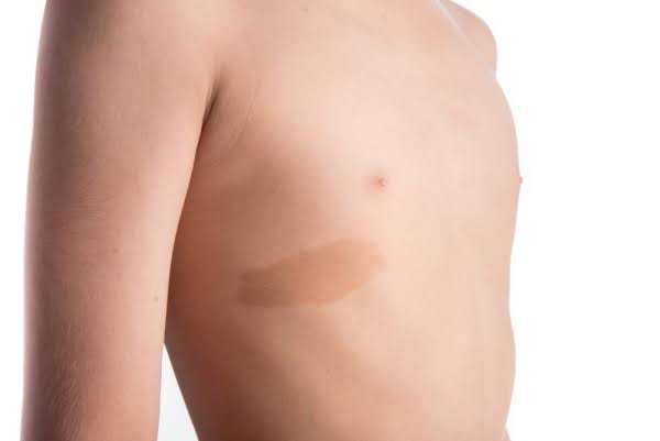 ปานสีกาแฟใส่นม (Café au lait) มีลักษณะอย่างไร? & ดูแลได้อย่างไร ? ปานสีกาแฟใส่นม (Café au lait) มีลักษณะอย่างไร? & ดูแลได้อย่างไร ?