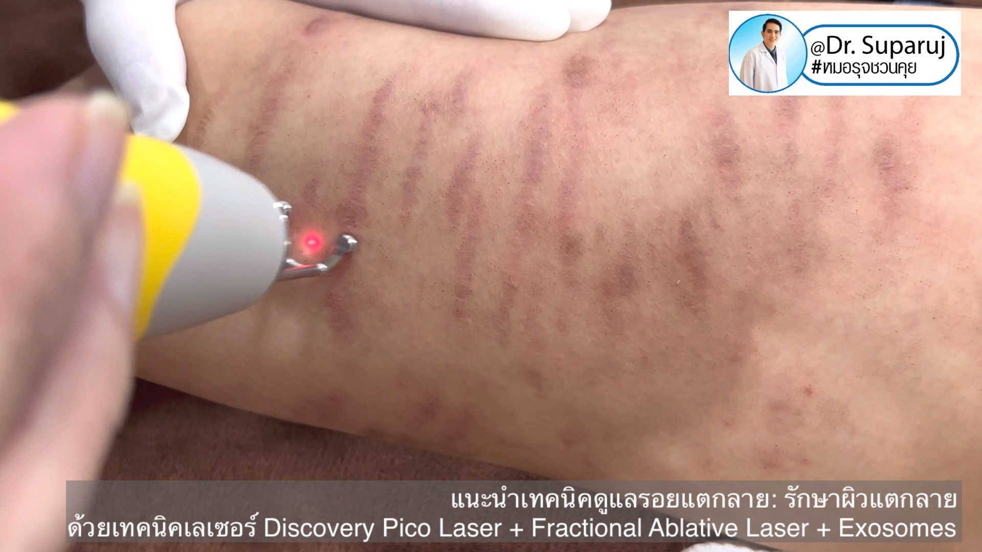 แนะนำเทคนิคดูแลรอยแตกลาย: รักษาผิวแตกลายด้วยเทคนิคเลเซอร์ Discovery Pico Laser + Fractional Ablative Laser + Exosomes แนะนำเทคนิคดูแลรอยแตกลาย: รักษาผิวแตกลายด้วยเทคนิคเลเซอร์ Discovery Pico Laser + Fractional Ablative Laser + Exosomes
