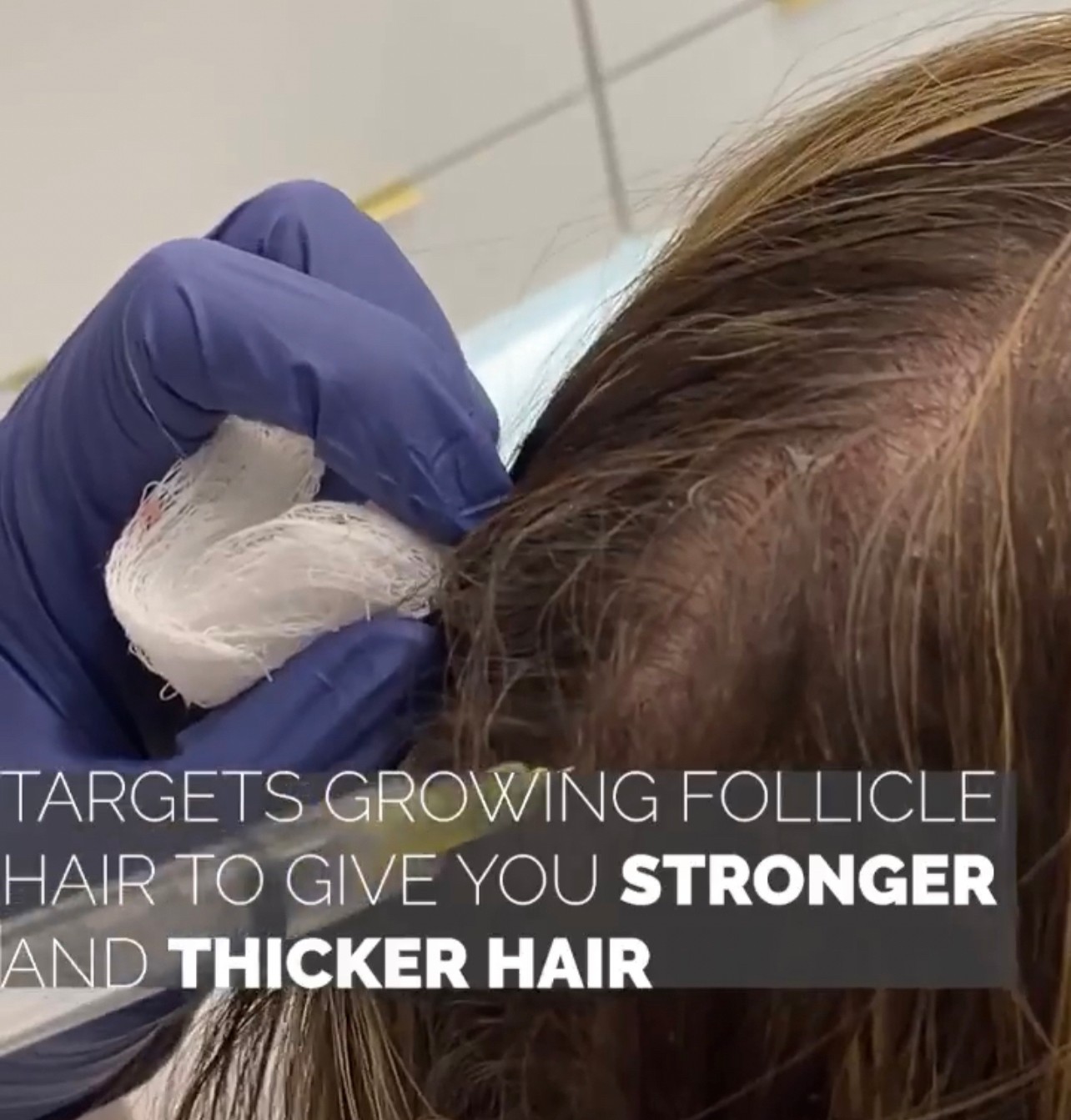 แนะนำเทคนิคดูแลปัญหาผมร่วงผมบาง: Exosome เอ็กโซโซม ช่วยดูแลผมร่วงผมบางได้อย่างไร? แนะนำเทคนิคดูแลปัญหาผมร่วงผมบาง: Exosome เอ็กโซโซม ช่วยดูแลผมร่วงผมบางได้อย่างไร?