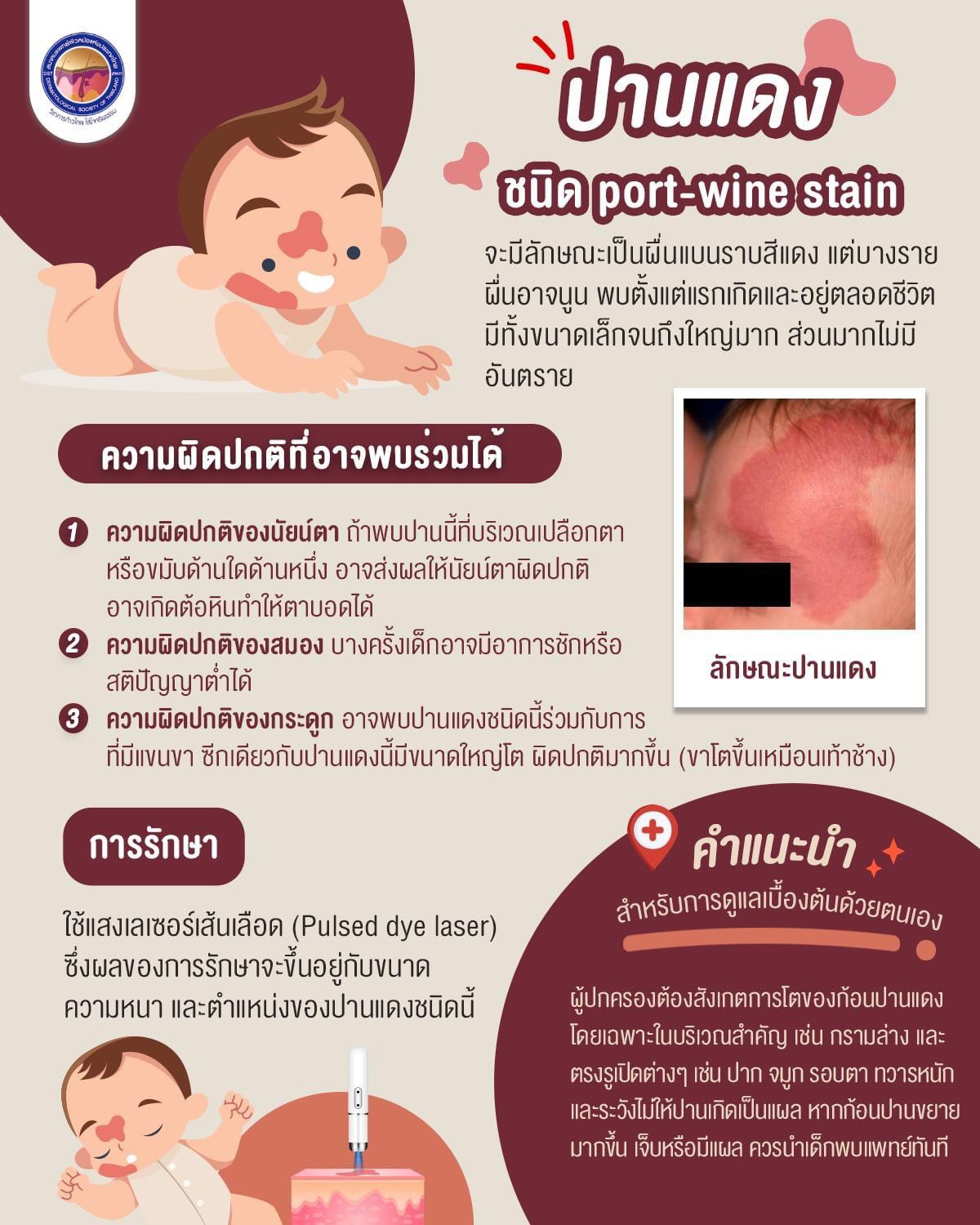 เทคนิคดูแลปานแต่กำเนิดด้วยเลเซอร์ดิสคัฟเวอรี่พิโค Birthmark Treatment with Special Handpieces of Discovery Pico Laser เทคนิคดูแลปานแต่กำเนิดด้วยเลเซอร์ดิสคัฟเวอรี่พิโค Birthmark Treatment with Special Handpieces of Discovery Pico Laser