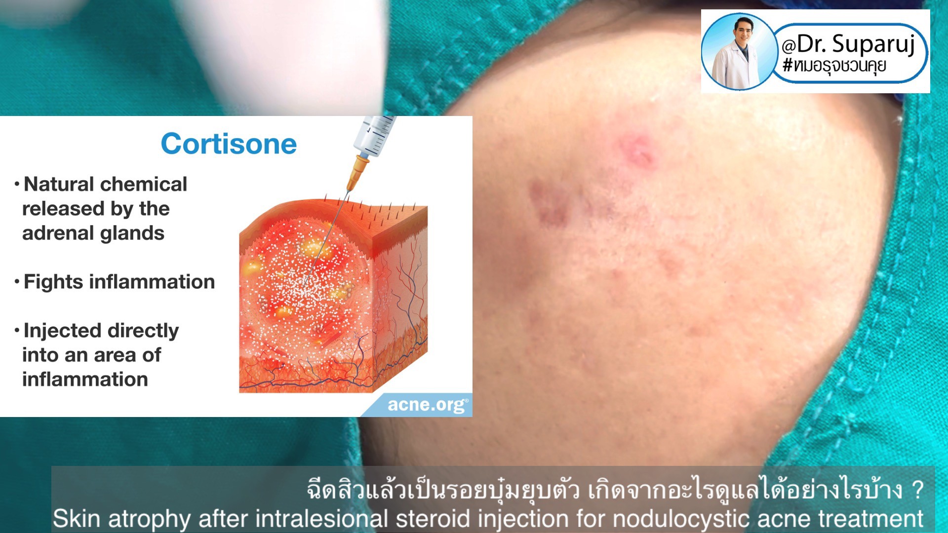 ฉีดสิวแล้วเป็นรอยบุ๋มยุบตัว เกิดจากอะไรดูแลได้อย่างไรบ้าง ? (Skin atrophy after intralesional steroid injection for nodulocystic acne treatment ) ฉีดสิวแล้วเป็นรอยบุ๋มยุบตัว เกิดจากอะไรดูแลได้อย่างไรบ้าง ? (Skin atrophy after intralesional steroid injection for nodulocystic acne treatment )