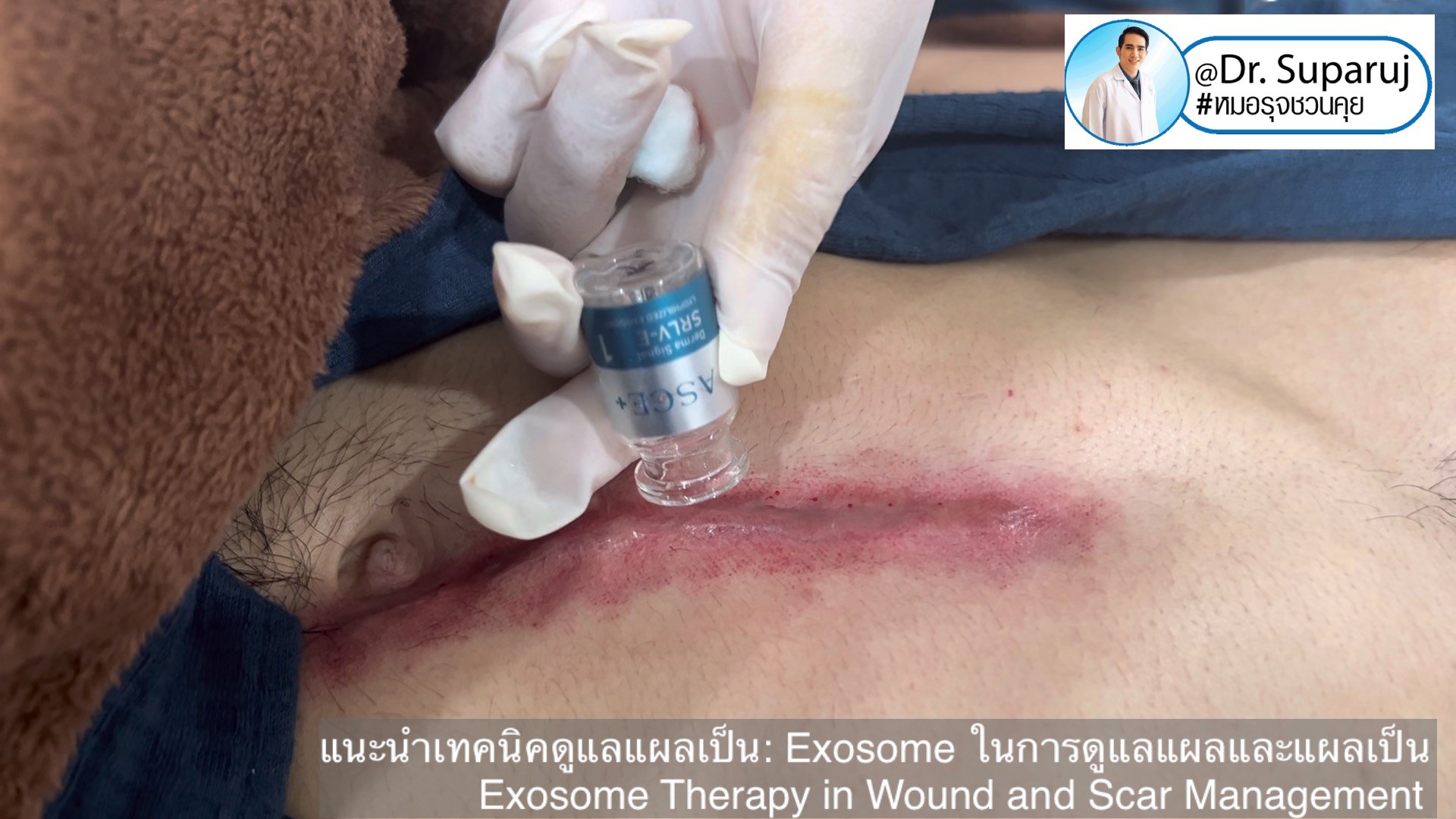 แนะนำเทคนิคดูแลแผลเป็น: Exosome ในการดูแลแผลและแผลเป็น Exosome Therapy in Wound and Scar Management แนะนำเทคนิคดูแลแผลเป็น: Exosome ในการดูแลแผลและแผลเป็น Exosome Therapy in Wound and Scar Management