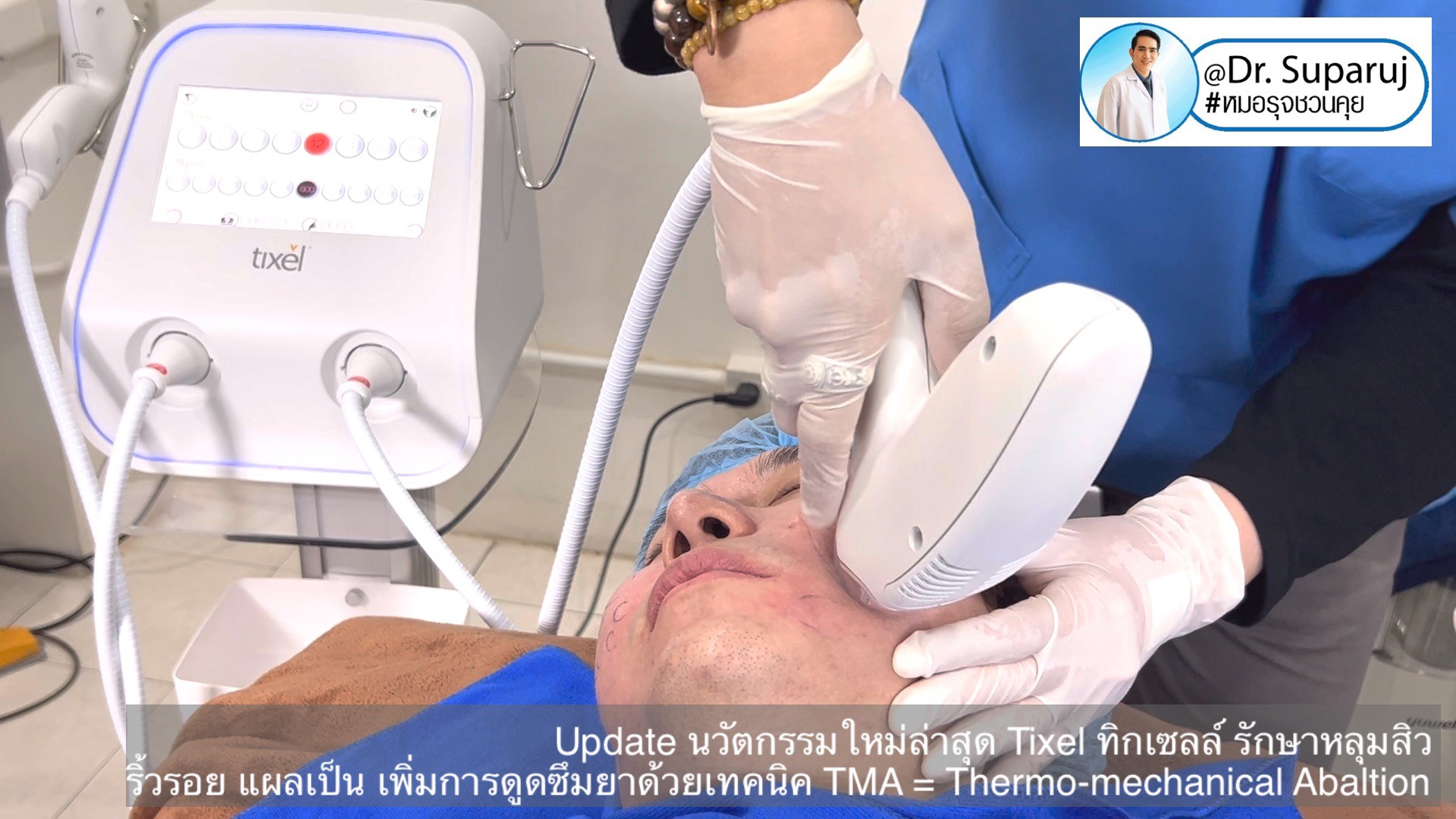 Update นวัตกรรมใหม่ล่าสุด Tixel ทิ๊กเซลล์ รักษาหลุมสิว ริ้วรอย แผลเป็น + Periorbital Tixel Treatment ดูแลริ้วรอยเปลือกตาและรอบดวงตาด้วยเทคนิค TMA = Thermo-mechanical Abaltion Update นวัตกรรมใหม่ล่าสุด Tixel ทิ๊กเซลล์ รักษาหลุมสิว ริ้วรอย แผลเป็น + Periorbital Tixel Treatment ดูแลริ้วรอยเปลือกตาและรอบดวงตาด้วยเทคนิค TMA = Thermo-mechanical Abaltion