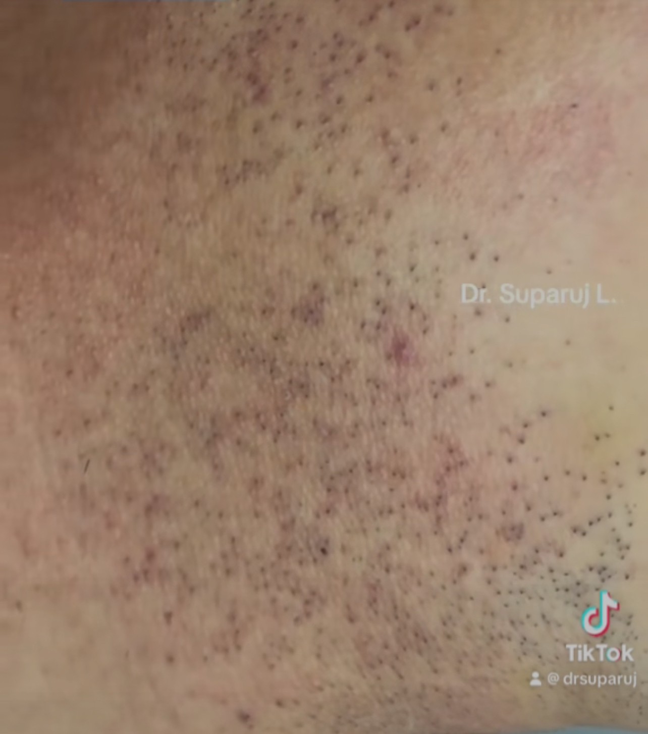 ขนคุดที่มีสีแดง KP Rubra มีลักษณะอย่างไร & ดูแลได้อย่างไร? ขนคุดที่มีสีแดง KP Rubra มีลักษณะอย่างไร & ดูแลได้อย่างไร?