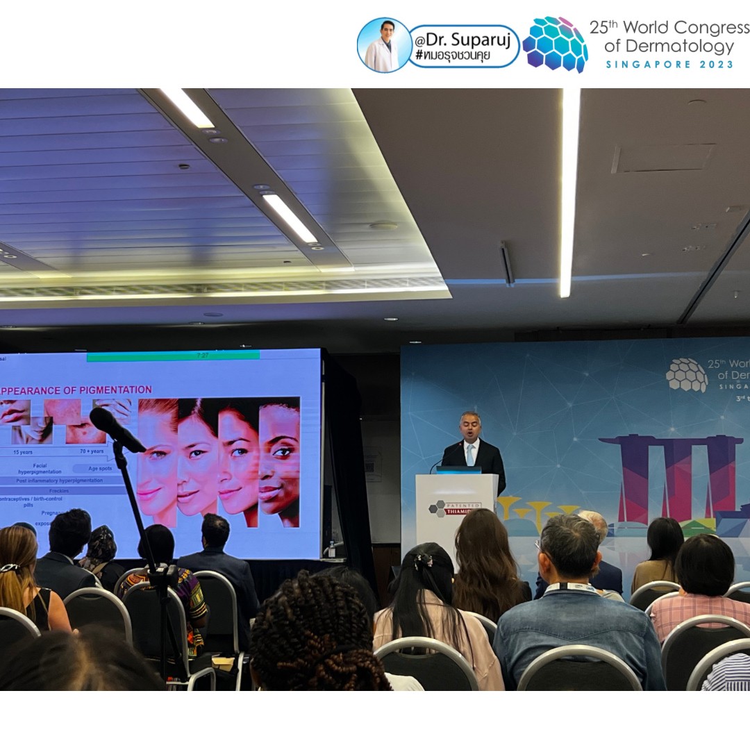 หมอรุจได้เข้าร่วมประชุม และนำเสนอผลงานวิจัยด้านการรักษาหลุมสิวแผลเป็นผมร่วงผมบาง ในงานประชุมแพทย์ผิวหนังระดับโลก World Congress of Dermatology WCD2023 ที่ประเทศสิงคโปร์ครับ หมอรุจได้เข้าร่วมประชุม และนำเสนอผลงานวิจัยด้านการรักษาหลุมสิวแผลเป็นผมร่วงผมบาง ในงานประชุมแพทย์ผิวหนังระดับโลก World Congress of Dermatology WCD2023 ที่ประเทศสิงคโปร์ครับ