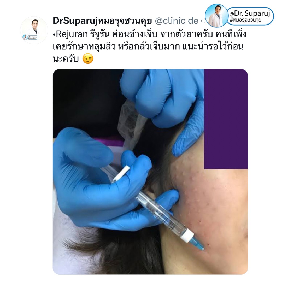 เป็นคนเจ็บง่าย (มากๆ) แต่อยากรักษาหลุมสิว มีเทคนิคอย่างไร? : เทคนิคลดอาการเจ็บจากการรักษาหลุมสิว เป็นคนเจ็บง่าย (มากๆ) แต่อยากรักษาหลุมสิว มีเทคนิคอย่างไร? : เทคนิคลดอาการเจ็บจากการรักษาหลุมสิว