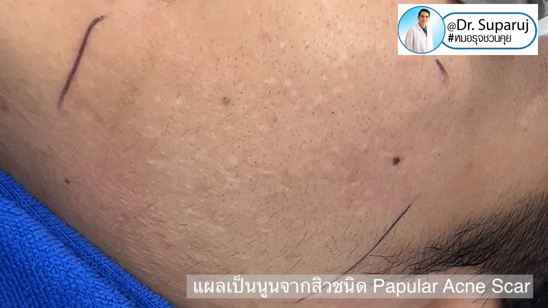 Back to the Basics: หลุมสิวมีกี่ชนิด & มีลักษณะอย่างไร ? Acne Scar Classification Full Clip คลิปเต็ม Facebook/ YouTube Dr. Suparuj หมอรุจชวนคุย ครับ Back to the Basics: หลุมสิวมีกี่ชนิด & มีลักษณะอย่างไร ? Acne Scar Classification Full Clip คลิปเต็ม Facebook/ YouTube Dr. Suparuj หมอรุจชวนคุย ครับ