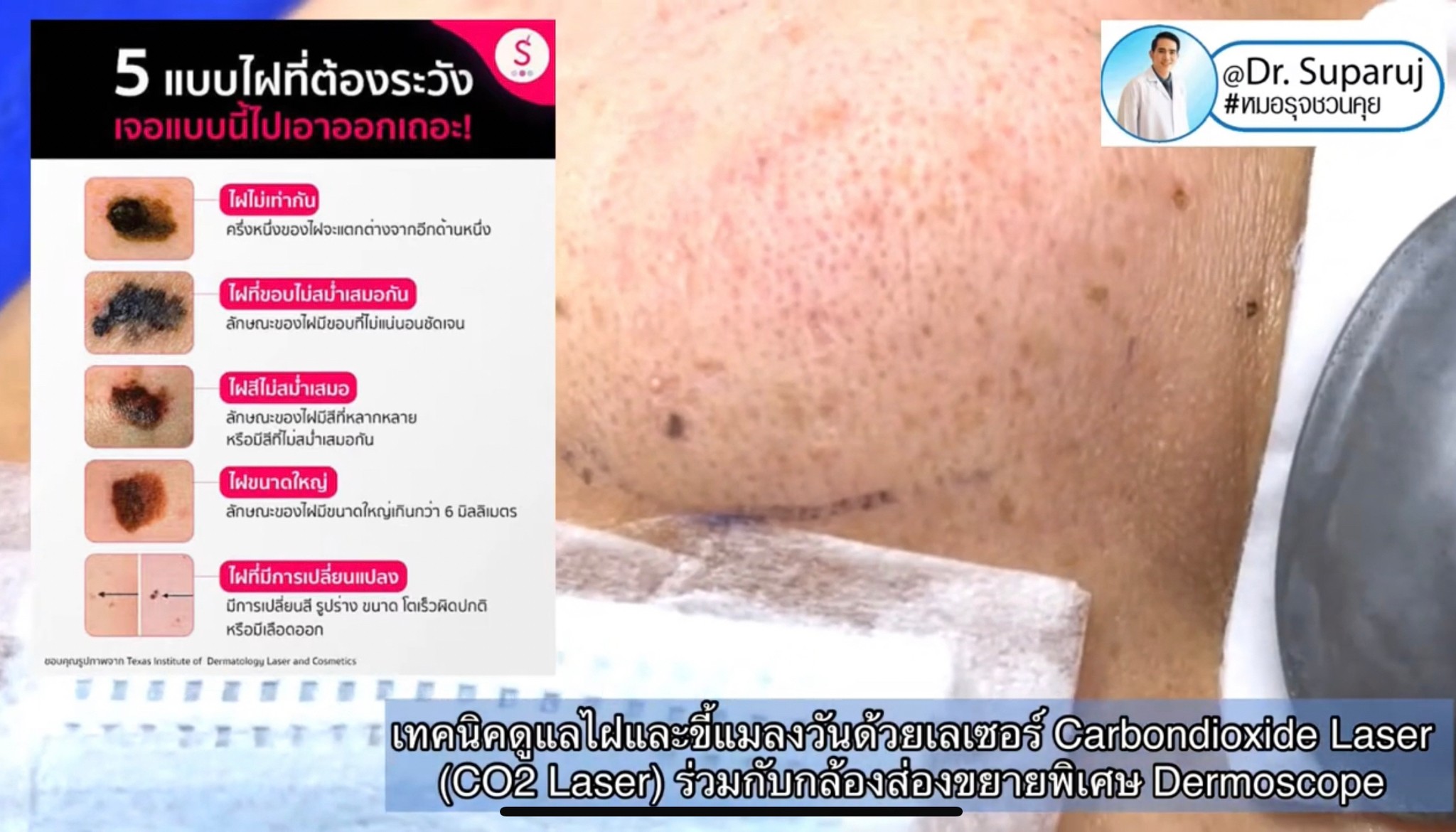 เทคนิคการใช้อุปกรณ์ช่วยวินิจฉัย & ดูแลปัญหาผิวหนัง ฝ้า กระ หลุมสิว: กล้องขยาย Dermoscopy, แว่นขยายพร้อมแสงในช่วงUV: Wood’s Lamp, เครื่องสแกนหาเส้นเลือด Vein Scanner เทคนิคการใช้อุปกรณ์ช่วยวินิจฉัย & ดูแลปัญหาผิวหนัง ฝ้า กระ หลุมสิว: กล้องขยาย Dermoscopy, แว่นขยายพร้อมแสงในช่วงUV: Wood’s Lamp, เครื่องสแกนหาเส้นเลือด Vein Scanner