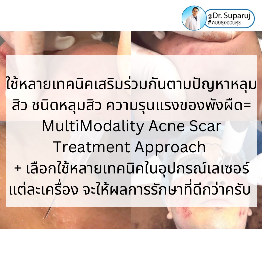 แนะนำเทคนิคดูแลหลุมสิว: เทคนิคการรักษาหลุมสิวชนิดไหนดีที่สุด? แนะนำเทคนิคดูแลหลุมสิว: เทคนิคการรักษาหลุมสิวชนิดไหนดีที่สุด?