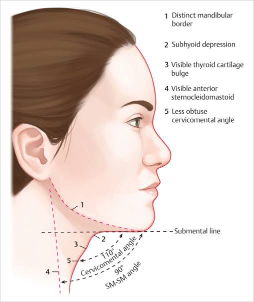 สาเหตุ & เทคนิคลดเหนียง ไขมันใต้คาง คาง 2 ชั้น Double Chin & Submental Fullness Treatment 