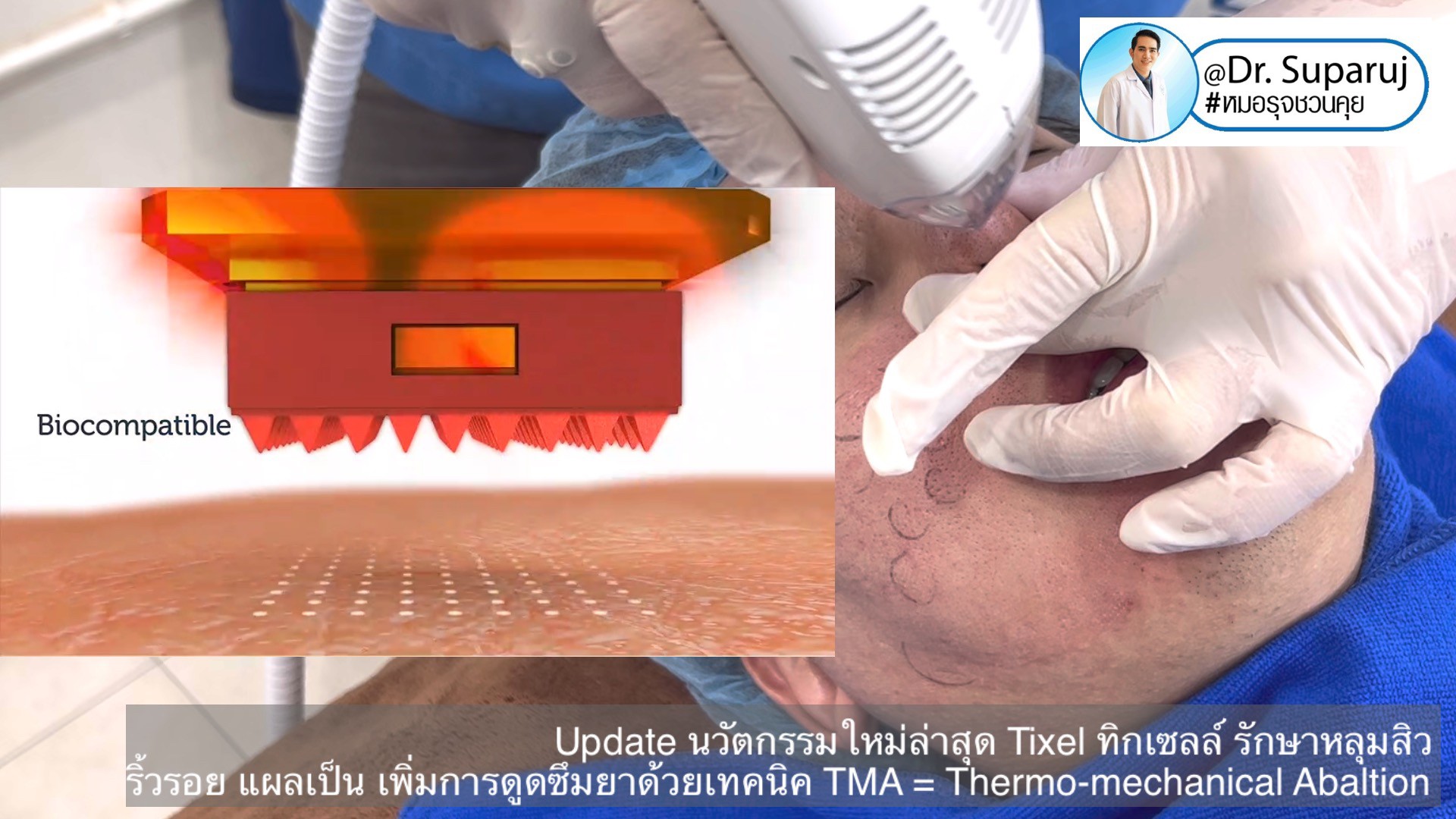 Update นวัตกรรมใหม่ล่าสุด Tixel ทิ๊กเซลล์ รักษาหลุมสิว ริ้วรอย แผลเป็น + Periorbital Tixel Treatment ดูแลริ้วรอยเปลือกตาและรอบดวงตาด้วยเทคนิค TMA = Thermo-mechanical Abaltion