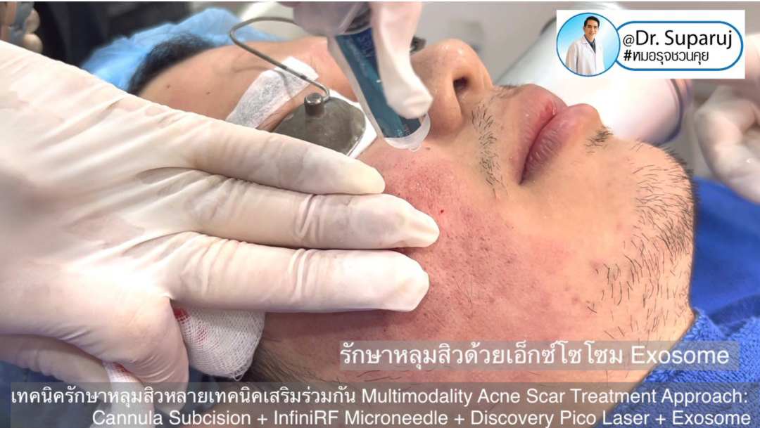 Exosomes มีบทบาทและกลไกในการดูแลฝ้า หรือไม่ & กลไกลเป็นอย่างไร ? Exosomes มีบทบาทและกลไกในการดูแลฝ้า หรือไม่ & กลไกลเป็นอย่างไร ?