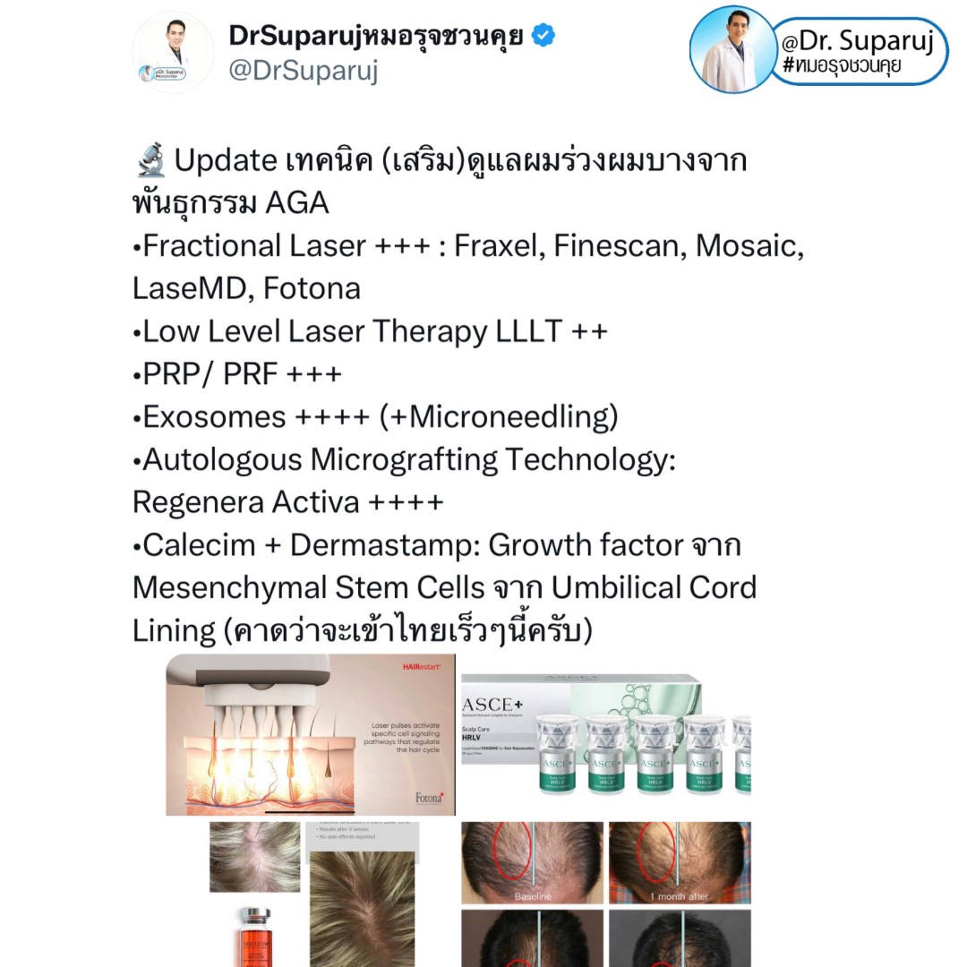 Update เทคนิค (เสริม)ดูแลผมร่วงผมบางจากพันธุกรรม AGA Update เทคนิค (เสริม)ดูแลผมร่วงผมบางจากพันธุกรรม AGA