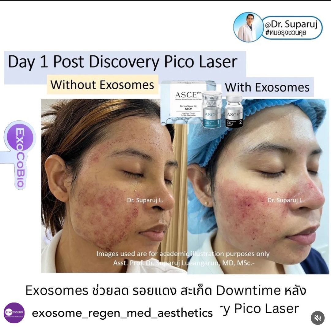 Exosomes มีบทบาทและกลไกในการดูแลฝ้า หรือไม่ & กลไกลเป็นอย่างไร ? Exosomes มีบทบาทและกลไกในการดูแลฝ้า หรือไม่ & กลไกลเป็นอย่างไร ?