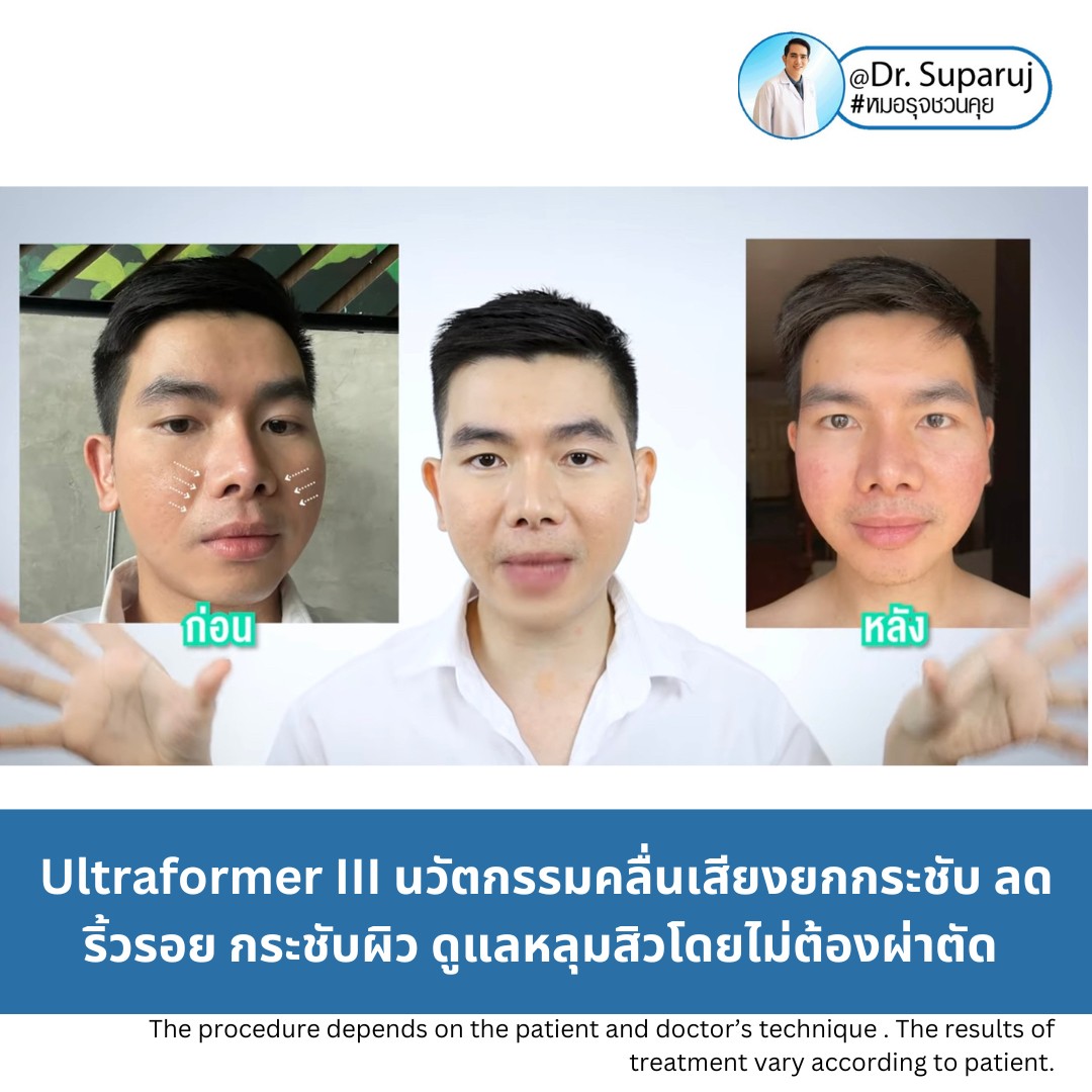 Update ผลการยกกระชับผิวด้วย Ultraformer III (เปรียบเทียบแบบครึ่งหน้าให้เห็นชัดๆครับ) Update ผลการยกกระชับผิวด้วย Ultraformer III (เปรียบเทียบแบบครึ่งหน้าให้เห็นชัดๆครับ)