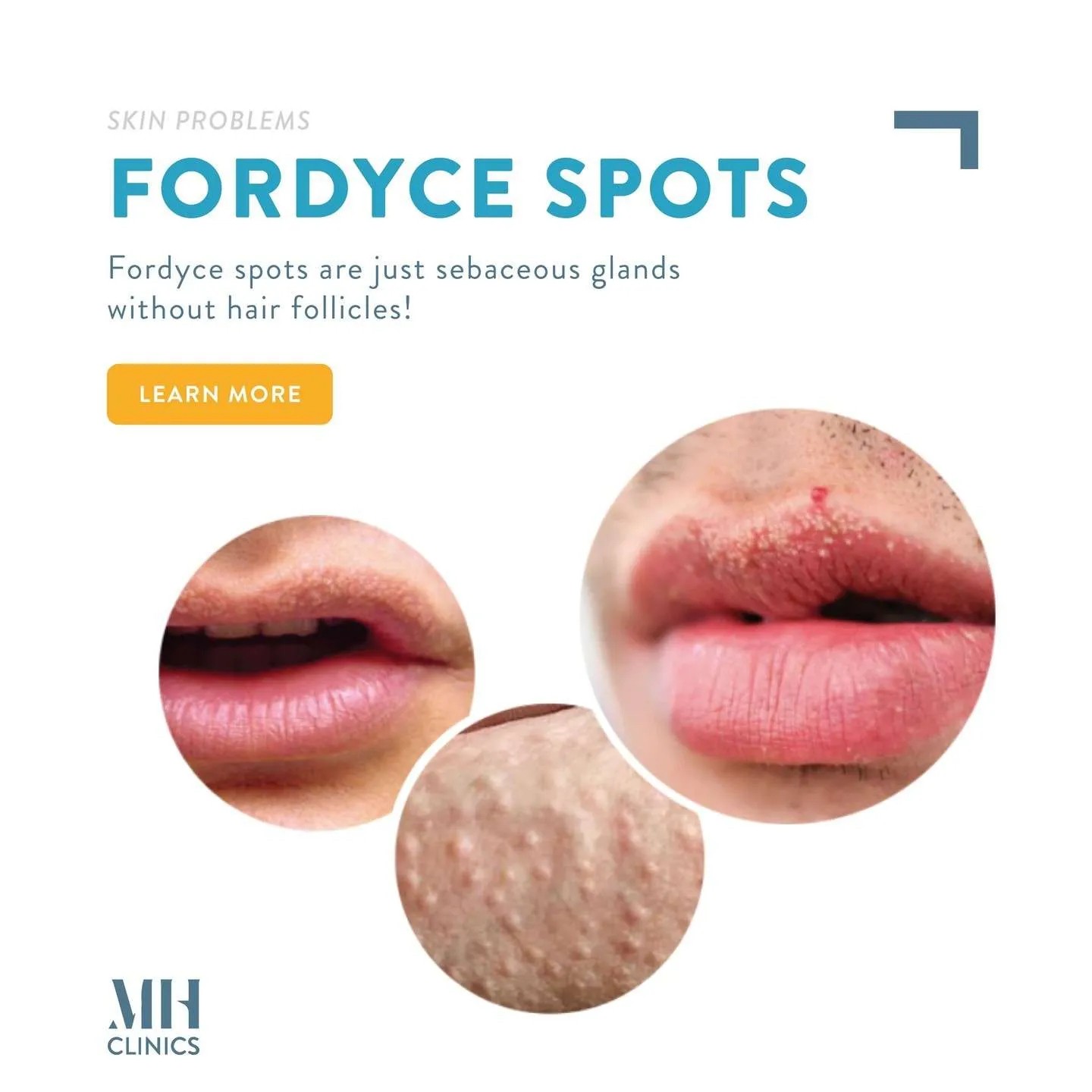  Fordyce Spot ตุ่มไขมันที่ริมฝีปาก คืออะไร มีลักษณะอย่างไร & มีวิธีดูแลได้อย่างไรบ้าง?