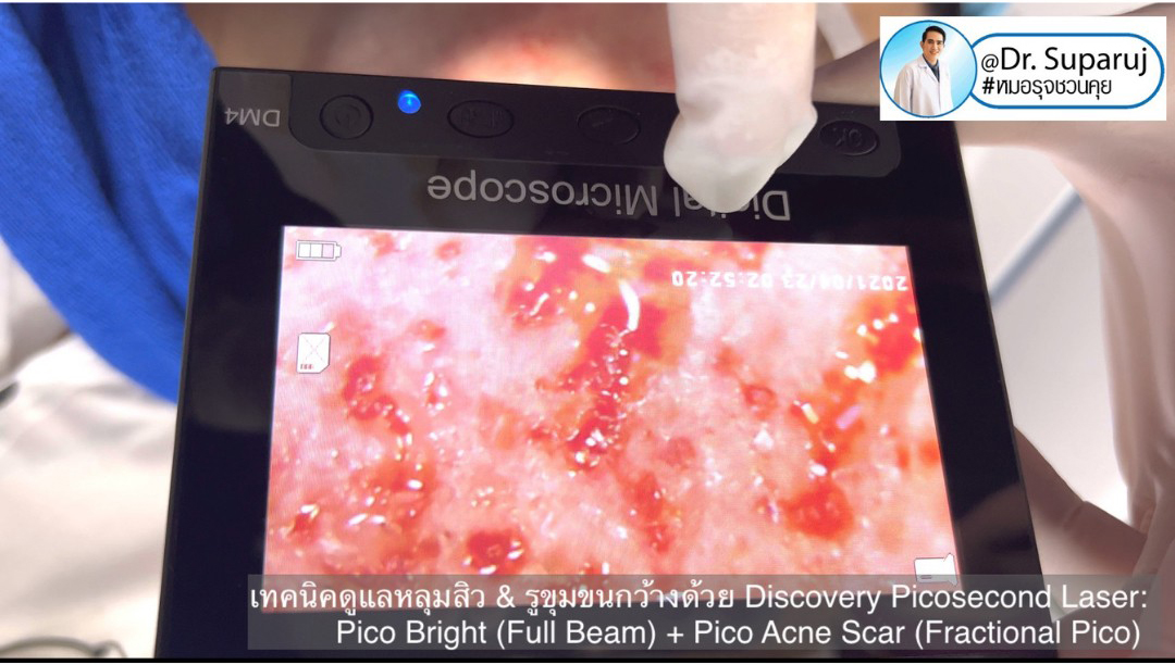 Update Discovery Picosecond Laser จุดเด่น & หลักการทำงาน ใช้ดูแลหลุมสิว แผลเป็น รอยแตกลาย ฝ้า กระจุดด่างดำ ได้อย่างไร ? 